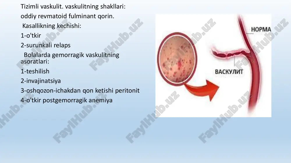 igini aniqlashda nefritning borishi haqida bashorat qilish, shuningdek davolash jarayonini nazorat qilish imkonini beradi. buyrak biopsiyasiga ko'rsatma davolashdan oldin yo'qolmaydigan glomerulonefrit belgilarining doimiy namoyon bo'lishi mumkin. gemorragik vaskulitni davolash bolalar: gemorragik vaskulit bilan og'rigan bolani davolash shifoxona sharoitida amalga oshiriladi. keyin u klinikada tekshiriladi va uyda kuzatiladi. kasalxonada davolanish muddati 3 haftadan 6 haftagacha. bolada kamida 3 hafta davomida yotoqda dam olishni kuzatish kerak, keyin u asta-sekin kengaytirilib, bolaning vaqti-vaqti bilan turishiga imkon beradi. kompleks davolash qat'iy dietani o'z ichiga oladi. bolalar uchun quyidagi mahsulotlar taqiqlanadi: kofe kakao va uni o'z ichiga olgan mahsulotlar shokolad (qora va sut) tsitrus mevalari yangi rezavorlar o'z ichiga olgan ovqatlardan foydalanishni cheklang: hayvon oqsillarining ekstraktiv moddalari ko'p miqdorda gistaminsiz bunday dorilarni davolash uchun foydalana olmaysiz:sulfanilamidlar antibiotiklar askorbin kislotasi kaltsiy preparatlari bolalardagi gemorragik vaskulitni davolashning asosi geparin terapiyasi hisoblanadi. geparin bolalarga 300-400 birlik / kg dozada avtokoagulyatsion test nazorati ostida buyuriladi. shuningdek, tizimli davolash qon …