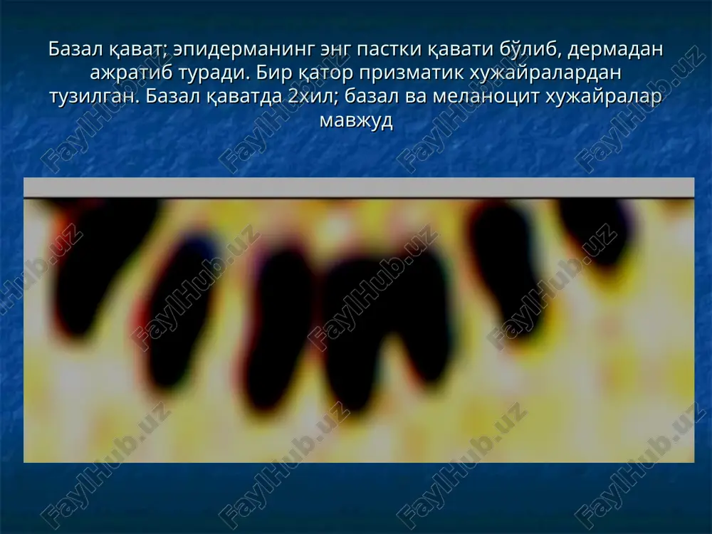 mkin pufaklar- ochilishi yoki qurishi natijasida qaloq xosil qilishi mumkin. o'rnida eroziya yoki turg'un bo'lmagan depigmentatsiya qoldiradi pufaklar-po'rsildoq yara, dyuring uchuqsimon dermatiti, streptokokkli impetigo, oyoq panjalari epidermofitiya kasalliklarida paydo bo'ladi yiringcha uch xil ko'rinishda bo'ladi 1)follikulyar yiringcha- 2) fliktena yiringcha-3) akne yiringcha –yarim sharsimon shaklda, o'lchami 1-10 mm. epiderma qavatidan tortib gipodermagacha tarqalishi mumkin. birlamchi pufakchalardan yoki ikkilamchi yallig'langan tugunchalardan xosil bo'lishi mumkin chuqur joylashgan yiringchalar o'zidan keyin chandiq qoldiradi ikkilamchi morfologik elementlar giperpigmentatsiya- terida melanin sintezining ko'payishi yoki birlamchi toshma o'rnida gemosiderin cho'kishi xisobiga xosil bo'ladi giperpigmentatsiya depigmentatsiya – terida melanin miqdorining kamayishi xisobiga xosil bo'ladi. birlamchi elementlar o'rnida vaqtinchalik yoki doimiy terining rangsizlanib qolishi depigmentatsiya qipiq- epidermisning shoxsimon qavati ba'zida uning ostidagi qavatlarining ko'chib tushishi xisobiga xosil bo'ladi qipiqlanishning tezlashishi-psoriaz, rang-barang temiratki, seboreya, ekzema,neyrodermit kabi kasalliklarda kuzatiladi eroziya-epiderma qismining defekti (jaroxatlanishi yoki etishmovchiligi). pufakchalar, pufaklar ochilishi xisobiga yoki tugunchalar yuzasi jaroxatlanganda xosil bo'ladi eroziyaning o'lchami birlamchi toshmaning o'lchamiga …