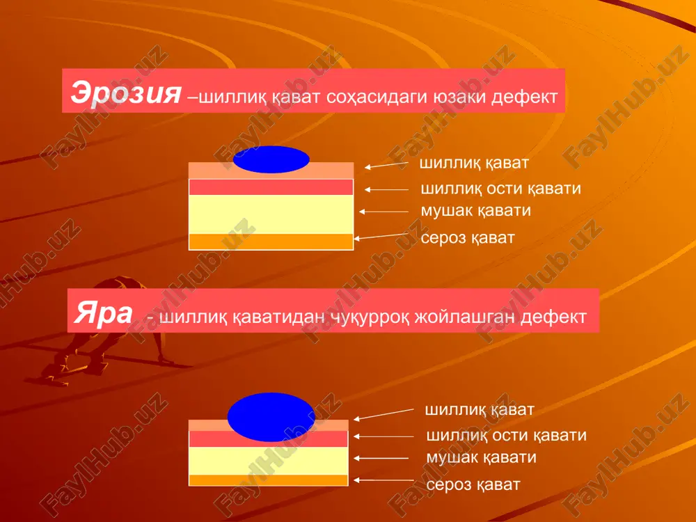 a , v chastnosti endoskopii , v bolshinstve sluchaev udaetsya ustanovit lokalnuyu prichinu krovotecheniya, v svyazi s chem stali viyavlyatsya neyazvennie krovotecheniya, chto vidno iz tablitsi. slayd №3,4 diagnostika boskichlari i boskich – kon ketish bormi? kayt kilish, ich kelishi xakida yolgon ma'lumotlar; anamnez (kayt kilish, najas, asosiy kasallik); ikkilamchi belgilar (bosh aylanishi, xolsizlik, teri okarishi, xushdan ketishlar); yurak faoliyatining buzilishi (yurak urish soni, ab, venoz bosim, tonlar); zondlash: kon tavsifi; tugri ichakni tekshirish; kon: er, hb, ht, ayukx, yukotilgan kon xajmi; ii boskich – kon ketish kaerdan (me'da yoki boshka soxadan)? - burundan, ogizdan, xalkumdan – anamnez, kurik; - xikildokdan – anamnez, yutalli ovoz. diagnostika boskichlari (davomi) iii boskich – me'da kasalliklariga boglik bulmagan me'dadan kon ketishning farklari: gemofiliya (anamnez, davomiyligi); verlgof kasalligi; leykoz, splenomegaliya; kapillyarotoksikoz (zaxarlanish, toshma, fgdfs); xafakon kasalligi; dori vositalariga boglik; uremik. iv boskich – individual aniklash. j.a.forrest (1974y.) buyicha kon ketish tasnifi * fia – …