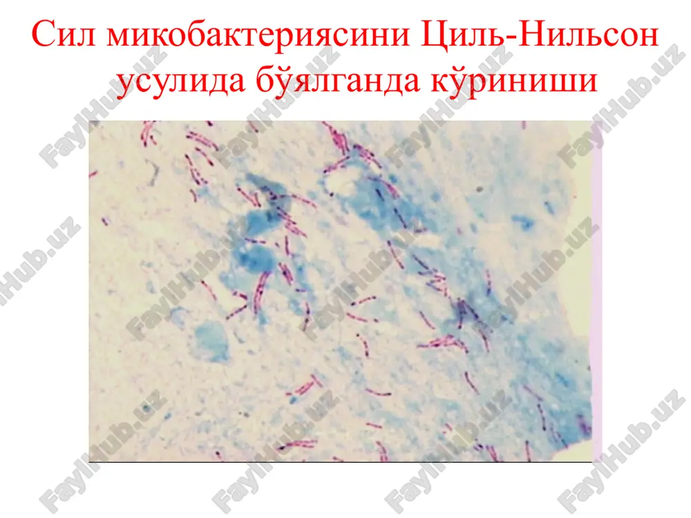 turuvchi diagnostik va davolovchi tekshiruvlarga bo'linadi. hozirgi vaqtda bronxoskopiyani fibrobronxoskop yordamida umumiy narkoz va miorelaksantlar bilan hamda mahalliy og'riqsizlantirish usulida amalga oshirish mumkin diagnostik bronxoskopiyaga asosiy ko'rsatmalar: -traxeya va bronxlar silining klinik belgilari mavjud bo'lganda; -traxeobronxial daraxtdagi nospetsifik yallig'lanishning klinik belgilari bo'lganda; -sil mikobakteriyalari ajralishining noaniq o'chog'ini topishda; -qon tuflash va qon ketishda; -«shishgan» yoki «yopilgan» kavaklar, ayniqsa «suyuqlik sathi» ni aniqlashda; -jarrohlik muolajasi yoki sun'iy pnevmotoraks qo'yishdan oldin; -operatsiyadan keyin bronx cho'ltog'ining holatini aniqlash va reviziya qilish; -noaniq kasalliklarda; -traxeobronxial daraxtni dinamikada kuzatishda (ilgari traxeya va bronxda sil, nospetsifik endobronxit aniqlangan bemorlar); -operatsiyadan keyingi atelektazlarda; -traxeya va bronxlardagi yot jismlarni topishda. bronxoskopiyaga moneliklar mutlaq moneliklar: -yurak-tomir tizimi kasalliklari: aorta anevrizmasi, yurak nuqsoni dekompensatsiya bosqichida, o'tkir miokard infarkti; -nafas etishmovchiligining 3 bosqichi; -uremiya, shok, bosh miya yoki o'pka tomirlari trombozi. bronxoskopiya — edinstvenniy na segodnyashniy den metod, pozvo- lyayushiy: vizualno issledovat sostoyanie vnutrenney poverxnosti traxei, bronxov vplot do subsegmentarnix i …