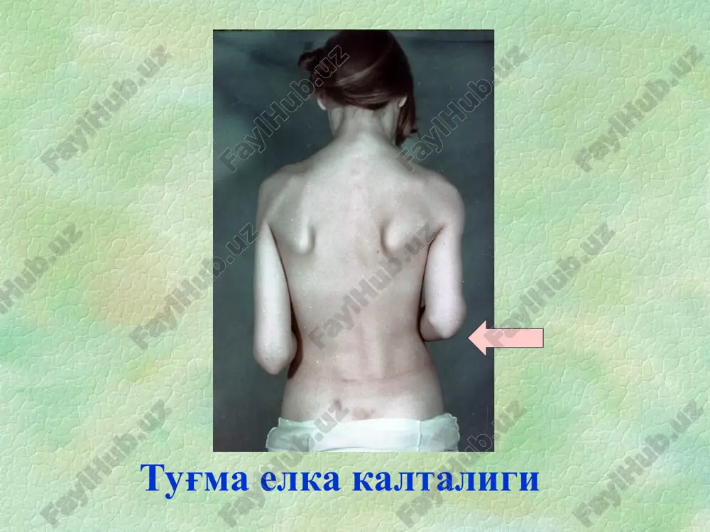 nservativ davolash davolash tug'ruqxonadan boshlanadi lfk, massaj, keng belash, freyk podushkasi (pampers) vilenskiy shinasi; shnayderova shinasi ; gnivkovskiy aparati ; operativ davo 2 yoshdan keyin amalga oshirish mumkin bo'g'im ichi operatsiyasi; bo'g'imdan tashqari ; kombinirlangan. atsetabulyar displaziyani davolash diagnoz qo'yilgach darhol boshlanadi. xar qanday darajadagi displaziyali bolalarda bajariladi. displaziyani davolash osteoartroz profilaktikasidir. davolash bukuvchi kontrakturani yo'qotish, son suyagi boshchasini to'g'rilash va markazlashtirishdan iborat son suyagi tug'ma chiqishini davolash manual to'g'rilash (lorents bo'yicha) skelet tortma qo'yilib, keyinchalik 6-8 dan 24 oyligigacha koksitli gips bog'lam bilan immobilizatsiyalanadi son suyagi tug'ma chiqishini davolash operativ davolash konservativ davo samara bermaganda yoki kech tashxis qo'yilganda amalga oshiriladi. tug'ma maymoqoyoqlik oyoqlarda eng uchraydigan tug'ma nuqson -12% o'g'il bola: qiz bola = 2:1 ko'proq o'ng tomonlama genetik moyillik bo'lishi mumkin tug'ma maymoqoyoqlik pes equinovaroexcavatus metatarsus adductus tug'ma maymoqoyoqlik pes equinovaroexcavatus metatarsus adductus tug'ma maymoqoyoqlik pes equinovaroexcavatus metatarsus adductus engil daraja. ekvinus ustunligi bilan tug'ma maymoqoyoqlik pes equinovaroexcavatus …