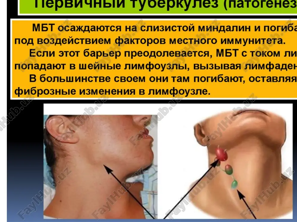 nit ekssudativnix plevrit (vsledstvie visokoy gipersensibilizatsii organizma); porajenie bronxov; gematogennaya, lifogennaya disseminatsiya (inogda mojet razvitsya miliarniy tuberkulez); narushenie bronxialnoy proxodimosti –atelektaz legkogo formirovanie bronxo- nodulyarnix svishey; formirovanie jelezistogo raspada oslojneniya tuberkuleza vnutrigrudnix limfaticheskix uzlov ekssudativniy plevrit disseminatsiya klinicheskiy sluchay bolnoy 3 goda. v tyajelom sostoyanii naydena skoroy pomoshyu na ulitse. rebenok iz tsiganskoy semi, gde viyavleni bolnie tuberkulezom. povishenie temperaturi tela do 38,50 s, odishka, maloproduktivniy kashel. srednie i nijnie otdeli pravogo legkogo zatemneni bez chetkoy verxney granitsi. korni legkix i verxnee sredostenie rasshireni, vospalitelno uplotneni, politsiklicheskie konturi korney prognoz pri tuberkuleze vnutrigrudnix limfaticheskix uzlov, osobenno maloy forme – blagopriyatniy, s polnim rassasivaniem spetsificheskogo vospaleniya limfoidnoy tkani i vizdorovleniem. otnositelno blagopriyatnim isxodom schitaetsya kaltsinatsiya limfouzlov, skleroz kornya legkogo, obrazovanie bronxoektazov. progressirovanie tuberkuleznogo protsessa svidetelstvuet o neblagopriyatnom techenii. isxodi i ostatochnie izmeneniya posle tuberkuleza vnutrigrudnix limfouzlov faza rassasivaniya (bipolyarnosti, sindrom redekkera) pervichnogo tuberkuleznogo kompleksa dlitelnost faz pervichnogo kompleksa isxodi pervichnogo tuberkuleznogo …