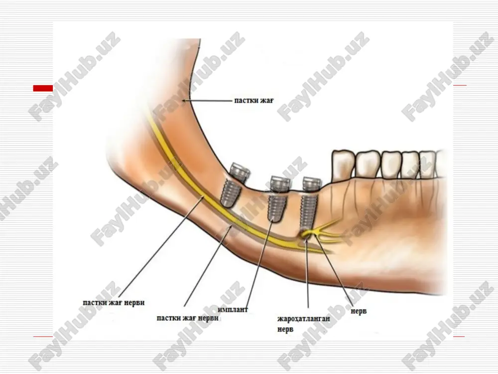asi va pastki jag' noto'liq adentiyalarida joylashishi. davo natijasi laborator model. yassi implantatni ijobiy tomonlari tor alveolyar o'siqlarda; kam chuqurlikda implantat qo'yish imkoniyati (gaymor bo'shliq, pastki alveolyar nerv); jag'larning tashqi va ichki kortikal plastinkalarini sinmasligi; suyak bilan katta maydonda kontakt hosil qilishi; shaklini xar xilligi, teshiklar va o'yiqlar borligi osteintegratsiya xolatini yaxshilaydi; implantat shaklini o'zgartirish mumkinligi; distal nuqsonlarda tayanch sifatida ishlatish mumkinligi (iplantat miqdorini kamaytirish imkoniyatini beradi); 3-4 xaftadan keyin ortopedik protez qo'yish imkoniyati bor. shilliq qavat kesimi vintli implantatni o'rnatish birinchi boskich implantat qo'yish joyini aniqlab olish yunaltiruvchi chuqur shakllantirish «pilot bor» yordamida. oxirgi chuqur shakllantirish implantat uchun rezba ochish implantatni joylashtirish. tikilgan yara vintli tiqin (zaglushka) o'rnatish. og'iz bo'shlig'ida tikilgan yara xolati. milk shakllantirgich o'rnatilgandan so'ng ikkinchi boskich milk shakllantirgich atrofidagi choklar xolati milk shakllantirgich olingandan so'ng, shakllangan transgingival kanal. milk shakllantirgich o'rnatilgach 12 kundan keyingi xolati. metallokeramik koronka o'rnatilgan suprastruktura (abatment). rentgenologik ta'svir (implantat qo'yilgandan z yildan …