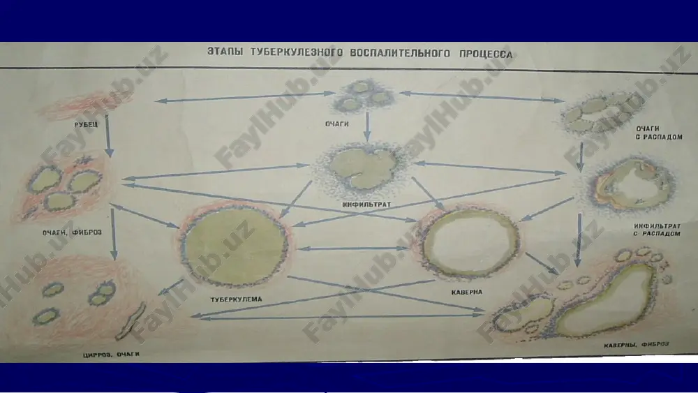 o'pkaning kavernali, fibroz-kavernali va tsirrotik tuberkulezi - Page 4