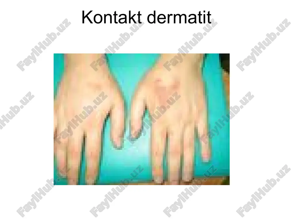 -10ml v/i №10 kalstiy xlor 10% -10ml v/i №10 magniy sulfat 25% -10ml m/o №10 2. enterosorbentlar: aktivlangan ko’mir, enterosorbent polifepan. 3. antigistaminlar - ketotifen - suprastin - analergin - diazolin - dimedrol - loratal - tavegil 4. vitaminlar: askorbin kislota, vitamin v guruxi 5. dezintoksikastion terapiya: gemodez, reopoliglyukin, natriy xlor, dekstran. 6. glyukokortikoidlar deksametazon, gidrokortizon, perednizolon 7. anabolik garmonlar 8. kaliy preparatlari mahalliy davolash - namli bog'lam qo’yish: 2% borat kislota, rivanol, rezorstin - anilin bo’yoqlari: fukorstin, metilin ko’ki, brilliant yashili. - epitelizastiya uchun gelva malhamlar: solkoseril, aktovegen, kuriozin. steroidli malhamlar va kremlar - antibiotikli malhamlar - ogiz shilliq pardalari uchun: furastilin, romashka 1%li borat kislota, kasalxonaga yotqizishga ko’rsatmalar kasallikning o’tkir kechishi umumiy axvolining ogirligi ish faoliyatining pasayishi ambulator davolashning samarasizligi qiyosiy tashxis 1. pushtirang temratki 2. zaxm 3. psoriaz 4. qizil yassi temratki 5. akantolitik pemfigus 6. lever pemfigoidi 7. dyuring dermatiti