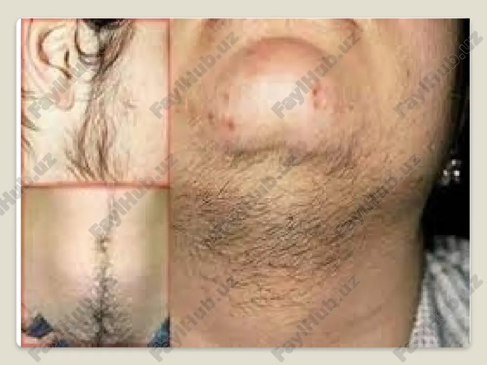 bezi tomonidan stimulyatsiyasi ovulyatsiyaga olib kelmaydi. androgenlarning ortiqcha ishlab chiqarilishi follikullar atreziyasiga, stroma va oqsil membranasining giperplaziyasiga olib keladi. bu shafqatsiz doirani yopadi va tsiklning uzilishlarini oshiradi. testosteronning ortiqcha bo'lishi erkak sindromi belgilarining namoyon bo'lishiga olib keladi. konjenital adrenal giperplaziya uchun jarrohlik davolash qo'llanilmaydi. tuxumdon o'smalari va buyrak usti o'smalarini maskulinizatsiya qilish uchun ko'rsatiladi. gipofiz adenomasini olib tashlash uchun neyroxirurgiya bo'limida kasalxonaga yotqizish kerak. jarrohlikdan keyin gamma nurlari yoki protonlar bilan radiatsiya terapiyasi kursi talab qilinishi mumkin. viril sindromini jarrohlik yo'li bilan tuzatish polikistik kasallik uchun samarali. laparoskopik kirish tuxumdonlarni xanjar rezektsiyasi yoki termal yoki lazer usullari yordamida kauterizatsiya qilish orqali amalga oshiriladi. tuxumdonlarning demodulyatsiyasi ham qo'llaniladi. aralashuvdan so'ng homiladorlik 6-12 oy ichida sodir bo'ladi, ammo keyinchalik kontseptsiya ehtimoli tezda pasayadi. klinik rasm virilizatsiyaning namoyon bo'lishi endokrin o'zgarishlar sodir bo'lgan yoshga bog'liq. kasallikning og'irligi qondagi androgenlarning ko'payishiga bog'liq. yangi tug'ilgan chaqaloqlarda virilizatsiya psevdohermafroditizmga olib kelishi mumkin. qiz bola erkaknikiga o'xshash …