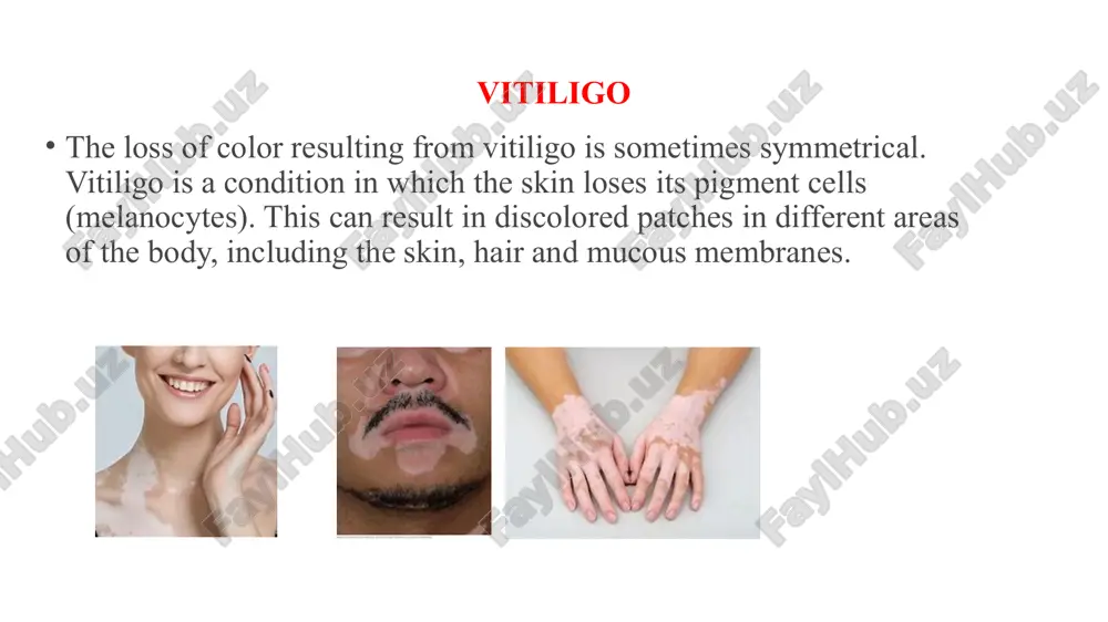 ypomelanosis tinea versicolor tuberculoid leprosy diagnosis an ultraviolet light can be used in the early phase of this disease for identification and to determine the effectiveness of treatment. using a wood's light, skin will change colour (fluoresce) when it is affected by certain bacteria, fungi, and changes to pigmentation of the skin. dr munir (dm) - treatment there is no cure for vitiligo but several treatment options are available.the best evidence is for applied steroids and the combination of ultraviolet light in combination with creams. due to the higher risks of skin cancer, the united kingdom's national health service suggests phototherapy be used only if primary treatments are ineffective. lesions located on the hands, feet, and joints are the most difficult to repigment; lesions on the face are easiest to return to the natural skin color as the skin is thinner in nature. treatment immune mediators topical preparations of immune …