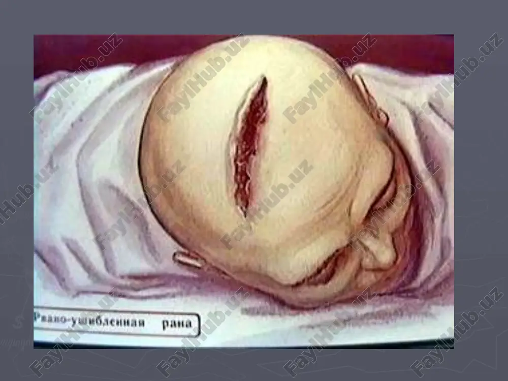 otsirkulyatsii – vajneyshiy faktor, opredelyayushiy effektivnost prochix lechebnix meropriyatiy: uluchshenie reologicheskix svoystv krovi – povishenie ee tekuchesti, snijenie agregatsionnoy sposobnosti formennix elementov dostigaetsya vnutrivennimi kapelnimi vlivaniyami reopolglyukina, rastvora albumina, vvedeniem kavintona, proizvodnix ksantina (eufillin, teonikol). pri nalichii subaraxnoidalnogo krovoizliyaniya - gemostaticheskaya antifermentnaya terapiya: 5% rastvor aminokapronovoy kisloti, kontrikal, trasilol, gordoks vnutrivenno po 25-20 tis. ed 2-3 raza v sut. sroki prebivaniya v statsionare bolnix s netyajelimi ushibami mozga pri neoslojnennom techenii - 21 sut. obyazatelna protivosudorojnaya terapiya - 6-12 mes. posle chmt. dozirovka preparatov (karbamzepin, paglyuferal) - v zavisimosti ot xaraktera povrejdeniya mozga, dannix eeg. lechebno-vosstanovitelniy kompleks - metabolicheskaya terapiya (nootropi, tserebrolizin), preparati, uluchshayushie tserebralnuyu mikrotsirkulyatsiyu (kavinton, tsinnarizin). osnovnie napravleniya kl pri ushibe mozga tyajeloy stepeni i ostrom travmaticheskom ego sdavlenii napravleniya lechebnix vozdeystviy dlya korrektsii narusheniy tserebralnoy mikrotsirkulyatsii: vnutrisosudistie vliyaniya – uluchshenie reologicheskix svoystv krovi, podderjanie vnutrisosudistogo davleniya; normalizatsiya sosudistogo tonusa, kontroliruemaya giperventilyatsiya, ispolzovanie vazoaktivnix preparatov; ustranenie perivaskulyarnogo oteka …