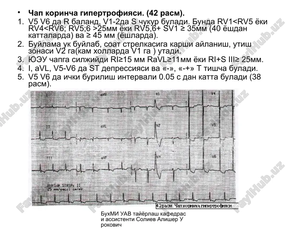 tal stenokardiyada st elevatsiyasi (tranmural ishemiya va kiska vaktli ishemik shikastlanish) mayda uchokli infarktdan farkli ravishda xurujdan sung 1 necha minut yoki soatdan sung uzgarishlar utib ketadi. buxmi uav tayyorlash kafedrasi assistenti soliev alisher urokovich mitral stenozda ekg. (49 rasm) sinusli ritmda ung korincha va chap bulmacha gipertrofiyasi (r-mitrale) xilpillovchi aritmiyada ung korincha gipertrofiyasi va bulmachalar xilpillashining katta tulkinli turi aniklanadi. buxmi uav tayyorlash kafedrasi assistenti soliev alisher urokovich mitral etishmovchilikda ekg(50 rasm) chap bulmacha va chap korincha gipertrofiyasi nukson katta bulganda chap bulmacha, va ikala korincha gipertrofiyasi aniklanadi. buxmi uav tayyorlash kafedrasi assistenti soliev alisher urokovich utkir upka yurakda ekg (51 rasm). qiii-si (qriii-rsi) iii, avf, v1, v2 da st kutariladi va i, avl,v5,v6 da st diskordant tushadi. iii, avf, v1, v2 da t tish manfiy buladi. giss tutami ung oyokchasining tulik yoki notulik blokadasi, ii, iii, avf da ung bulmacha zurikish belgilari (r-pulmonale), kasal axvoli yaxshilanganda, yukoridagi uzgarishlarda …