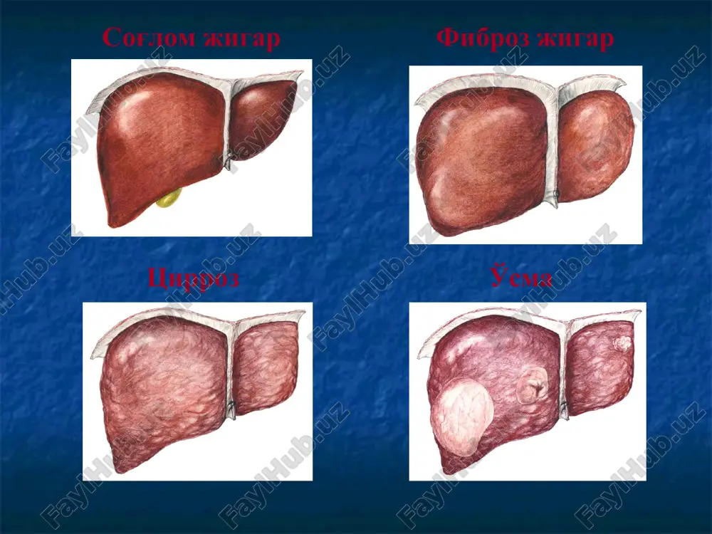 a obmena….. propedevtik bilimlar va shifokorning kuzatuvchanligi yutuqning muhim omillari bo'lib qoladi. astsit “caput meduza” ginekomastiya * * osmotr jivota pozvolit nam viyavit klassicheskie simptomi narusheniy funktsii pecheni astsita, i priznaki portalnoy gipertenzii – caput medusa. priznaki ginekomastii govoryat o glubokix narusheniyax sinteza gormonov. jigar tsirrozi dekompesatsiya boskichida «tomir yulduzchalari» (teleangiektaziya) jigar tsirrozida korin old devori venalarining kurinishi (caput meduzae). tug'ma portal gipertenziya klinikasi portal gipertenziyaning klinik manzarasi turli-tuman va ko'p jixatdan birlamchi kasallik xamda jigardagi jarayonga qo'shilgan blokadaga bogliq bolalarda aksariyat jigardan tashqari portal gipertenziya kuzatiladi. surunkali faol gepatitning klinik ko'rinishida ko'proq nevrologik va dispeptik o'zgarishlar ko'zga tashlanadi. bunga sekin-asta darmonsizlik, tez holsizlanish injiklik uyquning buzilishi va meteorizm qo'shiladi. tug'ma portal gipertenziya klinikasi tsirrozning doimiy simptomlaridan biri gepatosplenomegaliya 90—95% bemorlarda kuzatiladi. jigar chetlari dumaloqlashib, qattiqlashadi va yuzasida g'adir-budir bo'rtmachalar paypaslanadi keyinchalik qorin devori teri osti tomirlari kengayib, astsit va shishlar paydo bo'ladi jigar osti portal gipertenziyasi bo'lgan hollarda faqat …