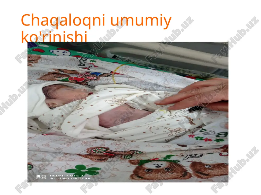 ktazi. pnevmopatiya fonidagi pnevmoniya otkir davri ogir shakli. asorati: gipoksik ishemik ensofolopatiya o'tkir davri og'ir daraja. umumiy susayish sindromi. xamroh: chaqaloqlar anemiyasi 3- daraja .ekstrimal kam vaznlik (900g). 28xafta. davolash rejasi: parvarish qilish ovqatlantirishni togri tashkil qilish antibiottik terapiya oksigenoterapiya infuzion terapiya simptomatik davo yangi tugilgan chaqaloqlarni parvarishlashda avvalmbor xona xaroratiga etibor beriladi.chala tugilan chaqaloqlarni xona harorati 26-28gradus kislorod kuvez harorati-33-34 gradus xavo namligi-90-60% namlik suv resursi hisobiga devorlari ikki qavat bu esa issiqlikni ushlab turish uchun yordam beradi. medikamentoz davolash sut miqdorini korrekaiya qilganimizda. deffisit 96ml . rp.: sol.glucose 10%-100ml. n 3 d.s 30ml dan vena ichiga infeksiya qilish uchun 1maxal rp.: sol. infusoli 250ml n 3 d.s 30ml dan vena ichiga infeksiya qilish uchun 1maxal rp.: sol. ringer lactat 200ml n 3 d.s 30ml dan vena ichiga infeksiya qilish uchun 1maxal pnevmoniyani davolash uchun: rp.: ceftraxioni 1.0 n10 d. s(50-70mg/kg) bir flakondagi dorini 0.9%-10ml fiz rastvorga eritib 0.5ml …