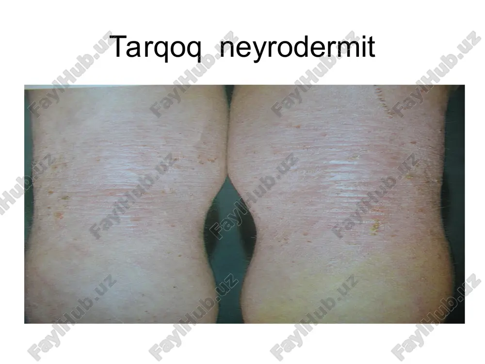 neyrodermatozlar tasnifi - Page 4