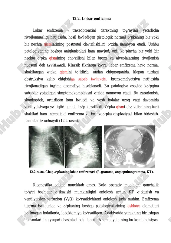 gan tug‘ma anomaliya hisoblanadi. bu patologiya asosida ko‘pgina sabablar yotadigan simptomokompleksni o‘zida namoyon etadi. bu zararlanish, shuningdek, orttirilgan ham bo‘ladi va yosh bolalar uzoq vaqt davomida ventilyatsiyaga yo‘liqtirilganida ko‘p kuzatiladi. o‘pka qismi cho‘zilishining turli shakllari ham interstitsial emfizema va bronxoo‘pka displaziyasi bilan birlashib, ham ularsiz uchraydi (12.2-rasm). 12.2-rasm. chap o‘pkaning lobar emfizemasi (r-gramma, angiopulmogramma, kt). diagnostika odatda murakkab emas. bola operativ muolajani qanchalik to‘g‘ri boshidan o‘tkazishi mumkinligini aniqlash uchun kt o‘tkazish va ventilyatsion-perfuzion (v/q) ko‘rsatkichlarni aniqlash juda muhim. emfizema tug‘ma bo‘lganida va o‘pkaning boshqa patologiyalarining oshkora alomatlari bo‘lmagan holatlarda, lobektomiya ko‘rsatilgan. adabiyotda yurakning birlashgan nuqsonlarining yuqori chastotasi belgilanadi. anomaliyalarning bu kombinatsiyasi zudlik bilan operatsiya o‘tkazilishini talab qilishi mumkin. lobar emfizemasining orttirilgan shakliga ega bolalaring tuzalishiga konservativ davolanish ham olib kelishi mumkin. bunday bemorlar, odatda, intensiv terapiya bo‘limida va ko‘pincha, monitoring ostida ventilyatsiyada joylashadi. bunday holatda «sog‘lom tomondan» selektiv bronxial intubatsiya zararlangan o‘pkani tuzalishni tezlashtirgan holda «izolyatsiyalashi» mumkin. 12.3. kistoz bo‘lmagan …