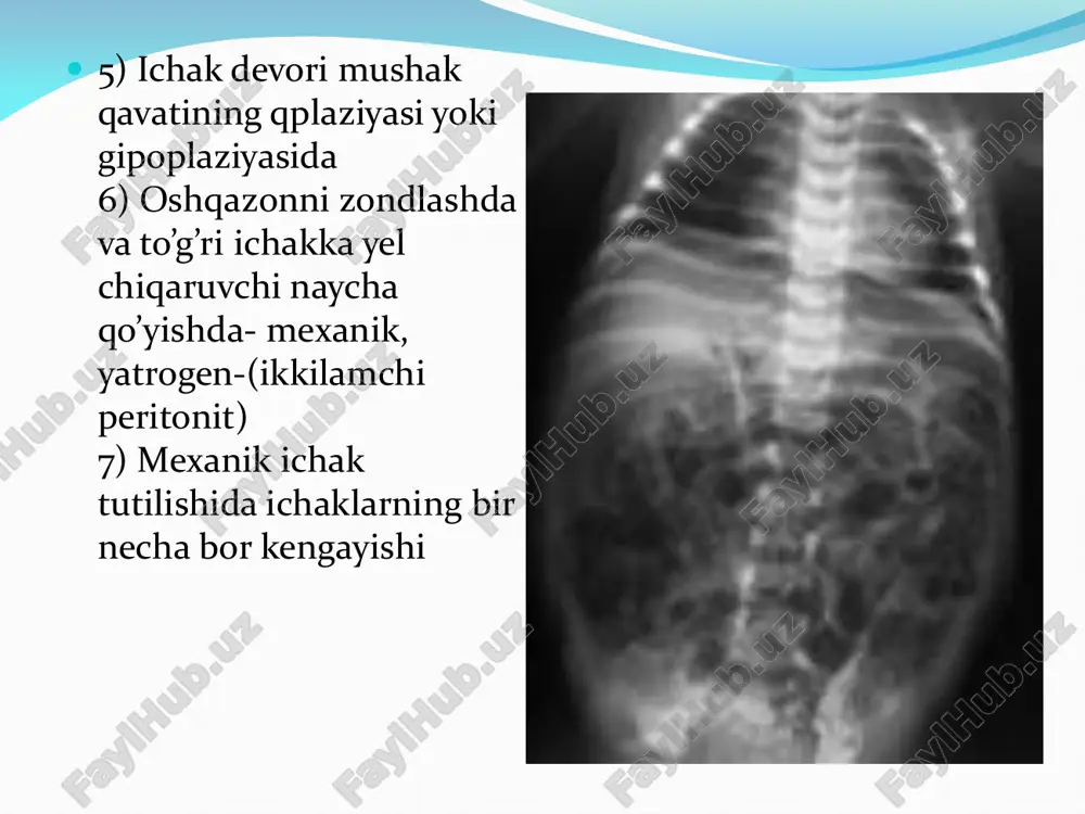 chaqaloqlarda peritonit - Page 4