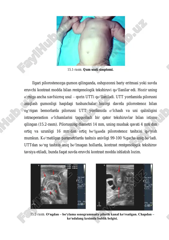 slaganda, harakatlanuvchi kattiq o‘smasimon hosilani aniqlashga, chuqurroq paypaslanganda barmoqlar orasiga ushlashga imkoniyat beradi. bu tashxislash usulini pilorostenoz bilan og‘rigan ko‘p bolalarda o‘tkazish mumkin va tashxisni to‘g‘ri qo‘yishda yordam beradi. bu tekshiruv usulini o‘tkazish uchun medikamentoz sedatatsiya qo‘llash mumkin. anamnez va klinik manzara asosida bolada pilorostenoz gumon qilinib, lekin pilorus paypaslanmasa, boshqa tashxislash usullaridan foydalanish lozim. pilorostenozga xos simptom- «qum soat» simptomi (15.1-rasm), bu simptom qorin oldi devorida barmoqlar bilan(«ko‘ylak» simptomiga o‘xshash) tez o‘tkazilganda kuzatiladi. 15.1-rasm. qum soati simptomi. ilgari pilorostenozga gumon qilinganda, oshqozonni bariy eritmasi yoki suvda eruvchi kontrast modda bilan rentgenologik tekshiruvi qo‘llanilar edi. hozir uning o‘rniga ancha xavfsizroq usul – qorin utti qo‘llaniladi. utt yordamida pilorusni aniqlash gumonligi haqidagi tushunchalar hozirgi davrda pilorostenoz bilan og‘rigan bemorlarda pilorusni utt yordamida o‘lchash va uni qalinligini intraoperastion o‘lchamlarini taqqoslash bir qator tekshiruvlar bilan istisno qilingan (15.2-rasm). pilorusning diametri 14 mm, uning mushak qavati 4 mm dan ortiq va uzunligi 16 mm …