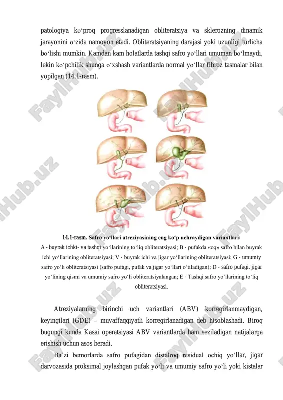 sindromi bilan birlashishini, sariq kasalligining postnatal davrda ko‘p paydo bo‘lishi va axolik stulning borligini, shuningdek, egizaklarning birida sariq kasalligining yo‘qligini va o‘lik tug‘ilganlarda safro yo‘llari atreziyasining kam uchrashi sabablarini tushuntirib berolmaydi. patofiziologiya. garchi «biliar atreziya» termini to‘liq obstruksiyaning static holati yoki safro yo‘llarining yo‘qligini ko‘zda tutsada, lekin aslida ushbu patologiya ko‘proq progresslanadigan obliteratsiya va sklerozning dinamik jarayonini o‘zida namoyon etadi. obliteratsiyaning darajasi yoki uzunligi turlicha bo‘lishi mumkin. kamdan kam holatlarda tashqi safro yo‘llari umuman bo‘lmaydi, lekin ko‘pchilik shunga o‘xshash variantlarda normal yo‘llar fibroz tasmalar bilan yopilgan (14.1-rasm). 14.1-rasm. safro yo‘llari atreziyasining eng ko‘p uchraydigan variantlari: a - buyrak ichki- va tashqi yo‘llarining to‘liq obliteratsiyasi; b - pufakda «oq» safro bilan buyrak ichi yo‘llarining obliteratsiyasi; v - buyrak ichi va jigar yo‘llarining obliteratsiyasi; g - umumiy safro yo‘li obliteratsiyasi (safro pufagi, pufak va jigar yo‘llari o‘tiladigan); d - safro pufagi, jigar yo‘lining qismi va umumiy safro yo‘li obliteratsiyalangan; e - tashqi …