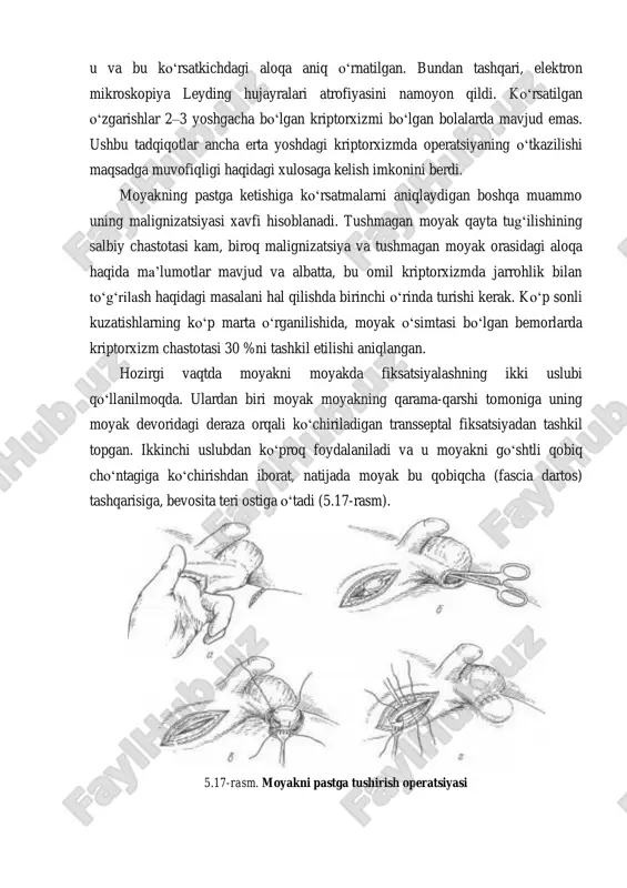 ushmagan moyak moyakda joylashgan moyakdan ko‘ra ancha yuqori temperatura ta’siriga uchraydi, degan gipoteza anchadan buyon mavjud. moyakning zararlanish darajasi temperatura ta’sirining davomiyligi (tug‘ilgandan operativ muolajagacha) va uning optimal darajadan yuqoriga ko‘tarilishiga bog‘liq (ya’ni moyakning tushmaslik darajasiga). qorin bo‘shlig‘ida joylashgan moyak chov kanalida joylashgan moyakdan ko‘ra, ancha yuqori temperatura ta’siriga uchraydi. mikroskopiya va shu qatorda, elektron mikroskopiyadan foydalanib o‘tkazilgan ancha keyingi tadqiqotlar kriptorxizmi bo‘lgan bemorlarda spermatogenozning ushlanishini namoyon qildi, bu spermatogonlar va kanallarning diametrik kamayishida ifodalanadi. bemor yoshi va kriptorxizmning darajasi bilan u va bu ko‘rsatkichdagi aloqa aniq o‘rnatilgan. bundan tashqari, elektron mikroskopiya leyding hujayralari atrofiyasini namoyon qildi. ko‘rsatilgan o‘zgarishlar 2–3 yoshgacha bo‘lgan kriptorxizmi bo‘lgan bolalarda mavjud emas. ushbu tadqiqotlar ancha erta yoshdagi kriptorxizmda operatsiyaning o‘tkazilishi maqsadga muvofiqligi haqidagi xulosaga kelish imkonini berdi. moyakning pastga ketishiga ko‘rsatmalarni aniqlaydigan boshqa muammo uning malignizatsiyasi xavfi hisoblanadi. tushmagan moyak qayta tug‘ilishining salbiy chastotasi kam, biroq malignizatsiya va tushmagan moyak orasidagi aloqa haqida ma’lumotlar mavjud …
