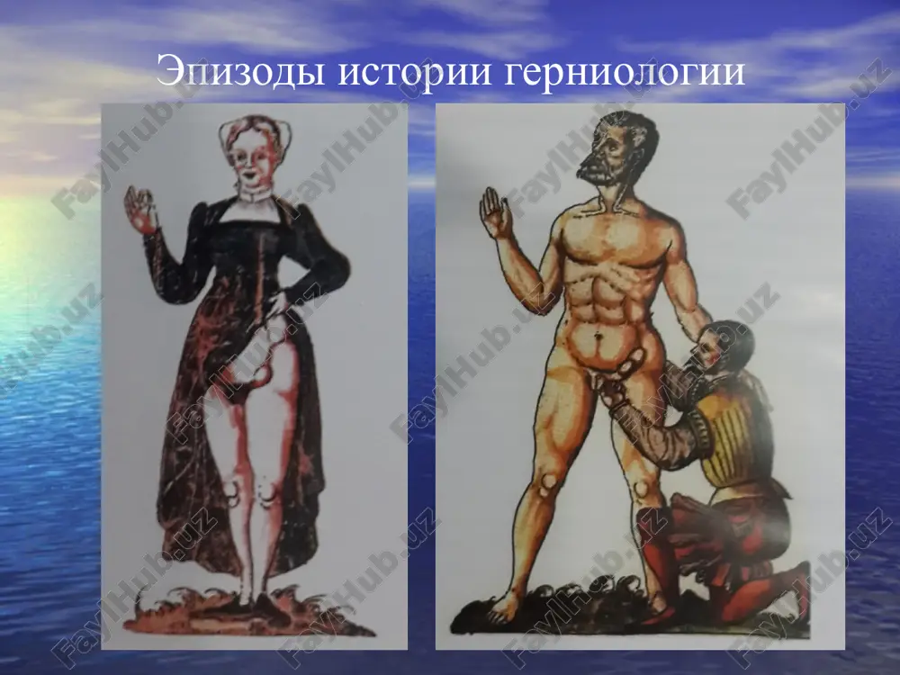 sii ne delat premedikatsii operatsiya -grijesechenie pod mestnoy anesteziey, reviziya grijevogo soderjimogo pri neobxodimosti – rezektsiya ushemlennoy kishki besshovnaya gernioplastika po trabukko laparoskopicheskoe grijesechenie rol vracha obshey praktiki v profilaktike i lechenie grij provedenie poyasnitelnix rabot s molodimi kormyashimi materyami po soblyudeniyu gigiene grudnix detey - uxode pupkom, pravilnoe kormlenie, regulyatsiya funktsii kishechnika propaganda sredi naseleniya zdorovogo obraza jizni, regulyarnogo zanyatiya fizkulturoy i sportom - sredstva ukrepleniya mishts i organizma voobshe. borba s ojireniem i s silnim istosheniem pravilniy podbor rabochix na fizicheskuyu rabotu v sootvetstvii s ix silami i sostoyaniem zdorovya. rannee viyavlenie lyudey, stradayushix grijami jivota, i napravlenie ix na operatsiyu do razvitiya oslojneniy.