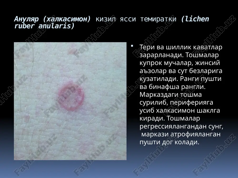 ilan yakka tashqi terapiya samarali emas; umumiy ta'sir kiluvchi dorilar va fototerapiya qo'llaniladi. og'ir holatlarda glyukokortikosteroid tabletkalaridan foydalanish mumkin (masalan, 2-6 hafta davomida kuniga 1 max 20 mg dozada prednizalon, so'ngra asta-sekin dozasi kamaytirgan xolda). glyukokortikosteroid dozasining pasayishi bilan kasallik takrorlanishi mumkin; ammo, glyukokortikosteroidlarni uzoq vaqt davomida ishlatmaslik kerak. davolash usullariga chidamliligiga karab retinoidlarni kullash (masalan, izotretinoin, roakuttan 30 mg dozada kuniga 1 marta, 8 hafta davomida) buyurilishi mumkin. 3 oydan 6 oygacha kuniga 2 marta 250 mg dozada griseofulvinga ijobiy ta'sir ko'rsatishi mumkin. agar kortikosteroidlar va retinoidlar samarasiz bo'lsa, tsiklosporin ishlatilishi mumkin (kuniga ikki marta 1,25 dan 2,5 mg / kg gacha). psoralenni ultrabinafsha a (puva) yoki tor diapazondagi ufo terapiyasi yordamida fototerapiya foyda beradi. davolash usullarining ko'pligi bilan har qanday kasallikda bo'lgani kabi, individual dorilar ham barcha bemorlarga bir xil ta'sir ko'rsatmaydi. image2.jpeg image3.jpeg image4.jpeg image5.jpeg image6.jpeg image7.jpeg image8.jpeg image9.jpeg image10.jpeg image11.jpeg image12.jpeg image13.jpeg image14.jpeg image15.jpeg image16.jpeg image17.jpeg …