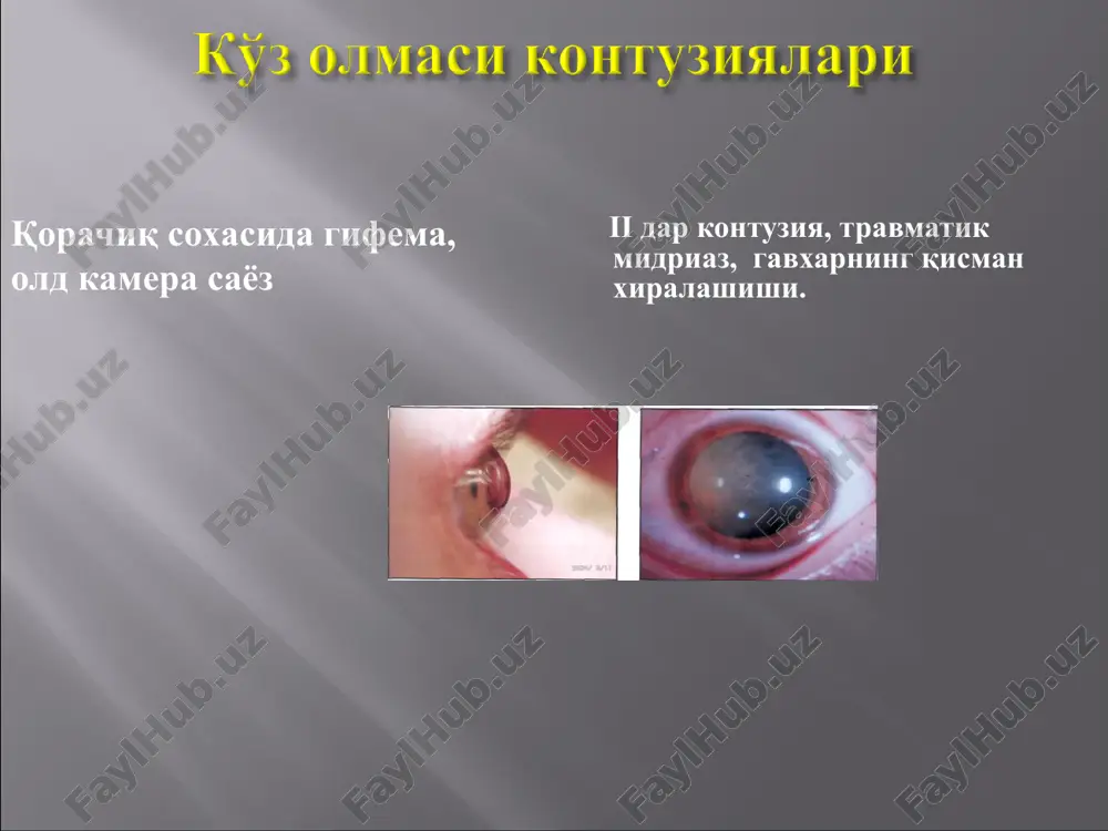 yaniya razriv sosudistoy obolochki, kraya kotorogo obrabotani argonovim lazerom razriv sosudistoy obolochki, kraya kotorogo obrabotani argonovim lazerom razriv sosudistoy, kraya kotorogo obrabotani argonovim lazerom mnojestvennie kontuzionnie razrivi sosudistoy, retinalnoe krovoizliyanie konservativ yallig'lanishga qarshi storoid va nosteroid preparatlar. deksazon, oftan-deksametazon, maksideks, maksitrol, indokollir, indometatsin, metindol, diklofenak, ibuprofen va boshqalar; birinchi xaftada antifibrinolitiklar:gordoks, kontrikal, ingitril, traksilol, amiiokapron kislota; fibrinolitiklar: gemaza, streptodekaza, vobenzim, fibrinolizin, kollalizin; proteaza ingibitorlari (og'ir kontuziyalarda maxalliy qullaniladi); antioksidantlar: emoksipin, taufon, tsitoxrom s, askorbinovaya i lipoevaya kislota, rutin i drugie; peptid bioregulyatorlari (retinalamin, korteksin); gipotenziv dori vositalari preparatov (fotil, arutimol, azopt, trusopt); diuretiklar.