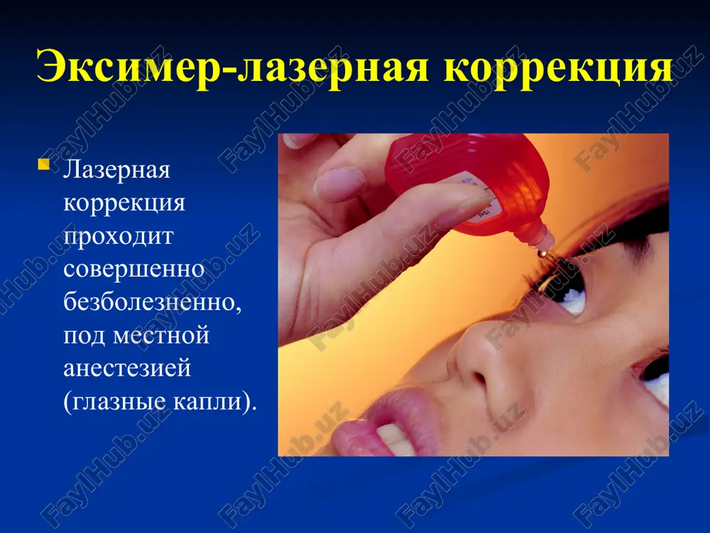 ya operatsii; prognoziruemost effekta; stabilnost rezultatov. preimushestva operatsii frk lasik ( lazerniy keratomilyoz ): predstavlyaet soboy sovremenniy vid korrektsii zreniya - unikalnuyu kombinatsiyu mikroxirurgicheskoy i eksimer-lazernoy texnologiy. eto "shadyashiy" i effektivniy metod, soxranyayushiy anatomiyu sloev rogovitsi. prakticheski ne imeet ogranicheniy po korrektsii lyuboy stepeni anomaliy refraktsii. costoit iz 2- x kombinirovannix etapov operatsii: 1 etap vklyuchaet ispolzovanie unikalnogo avtomaticheskogo mikroxirurgicheskogo instrumenta, kotoriy otkrivaet dostup k srednim sloyam rogovichnoy tkani. eta protsedura zanimaet 2 - 5 sekund i absolyutno bezboleznenna. mikrokeratom firmi "moria", (frantsiya) - "lsk evolution" s pomoshyu mexanicheskogo instrumenta - mikrokeratoma - v zashitnom sloe rogovitsi obrazovivaetsya krugliy klapan. 2 etap ispolzovanie upravlyaemogo sovremennim kompyuterom visokotochnogo eksimernogo lazera sozdayot noviy profil rogovitsi, obespechivayushiy fokusirovku luchey tochno na setchatke glaza. eksimer-lazernoy ustanovka "nidek", (yaponiya)- "nidek ec-5000". verxnie sloi stromi rogovitsi isparyayutsya eksimernim lazerom na neobxodimuyu dlya vosstanovleniya tochnoy fokusirovki glubinu. zashitniy sloy vozvrashaetsya na mesto i plotno prilegaet k obrabotannomu …