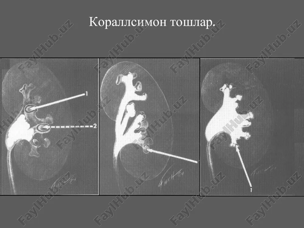 olib tashlash uchun eztl (e u v l) ekstrakorporal zarba -tulkinli litotripsiya toshlarni olib tashlash samaradorligi darajasi (stone-free): diametri 10 mm dan kam bulgan toshlar - 84% (64-92%). diametri 10 – 20 mm bulgan toshlar - 77%. diametri 20 mm dan katta bulgan toshlar - 63% (39-70%). eztl usulida buyrak toshlarini olib tashlash euvl buyrak toshlarini olib tashlash uchun «toshli yulakcha»– bu mayda toshlarni yoki tosh fragmentlarini siydik nayida tuplanib kolishi bulib, optimal xavfsiz vakt davomida siydik nayidan chikib ketmaydi va siydikning erkin okimini kiyinlashtiradi . «toshli yulakcha» (steinstrasse) «toshli yulakchani» davolash metodlari. euvl- ekstrakorporalnaya udarno-volnovaya litotripsiya, urs- ureterorenoskopiya, pn- perkutannaya nefrostomiya lokalizatsiyasi obstruktsiya yuk obstruktsiya yoki simptomlar bor bulsa. siydik nayi yu/3 kismida eztl pn stentlashe eztl siydik nayi u/3 kismida eztl pn stentlash eztl siydik nayi p/3 kismida eztl urs pn eztl urs ureterolitoekstraktsiya (ureterolitotripsiya) urs toshlarni olib tashlashda urs siydik nayi toshlarini olib tashlash. endoskopik litotripsiya toshlarni …
