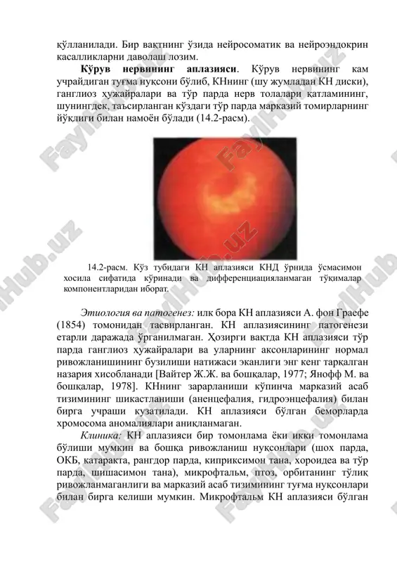 birga uchrashi kuzatiladi. kn aplaziyasi bo'lgan bemorlarda xromosoma anomaliyalari aniqlanmagan. klinika: kn aplaziyasi bir tomonlama yoki ikki tomonlama bo'lishi mumkin va boshqa rivojlanish nuqsonlari (shox parda, okb, katarakta, rangdor parda, kipriksimon tana, xoroidea va to'r parda, shishasimon tana), mikroftalm, ptoz, orbitaning to'liq rivojlanmaganligi va markaziy asab tizimining tug'ma nuqsonlari bilan birga kelishi mumkin. mikroftalm kn aplaziyasi bo'lgan deyarli barcha bemorlarda kuzatiladi. kn aplaziyasi bilan og'rigan bemorlarda qorachiqning yorug'likka bevosita reaktsiyasi bo'lmaydi. odatda, kn aplaziyasi patomorfologik tadqiqotlar davomida hayot bilan mos kelmaydigan qo'pol neyrosomatik malformatsiyalar holatida aniqlanadi. ko'pincha doimiy va asosiy xususiyati bo'lib to'r parda markaziy tomirlarning yo'qligi xisoblanadi. aplaziyada kn diskida o'zgarishlar turlicha bo'lib, o'zini quyidagicha namoyon qilishi mumkin: 1. kn diski, markaziy tomirlar va makula differentsiatsiyasi bo'lmaydi. 2. to'r pardaning markaziy tomirlardan mahrum bo'lgan rudimentar oq kn diski ko'rinadi, makulyar refleks aniqlanmaydi. 3. oftalmoskopiyada kn diski o'rnida peripapillyar skleral konusni eslatuvchi, yorug' halqa bilan o'ralgan, chuqur bo'shliq aniqlanadi. to'r …