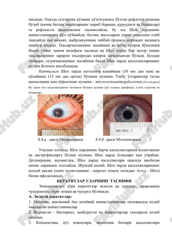 hik begona jismlarning kirib borishi, quruqligi va boshqalar) ga refleksli reaktsiyasini ta'minlaydi, bu esa shox pardaning shikastlanishiga yo'l qo'ymaydi, begona jismlarni uning yuzasidan olib tashlaydi yoki nihoyat, jabrlanuvchini tibbiy yordamga murojaat qilishga majbur qiladi. ta'sirchanlikning pasayishi va hatto ko'proq yo'qolishi bilan uning himoya vazifasi pasayadi va shox parda bir qator tashqi ta'sirlarning zararli ta'siridan kamroq himoyalangan bo'ladi. bundan tashqari, sezuvchanlikning pasayishi ba'zi shox parda kasalliklarining muhim belgisi hisoblanadi. kattaligi shox parda kattaligi kamayishi (10 mm dan kam) va ko'payishi (13 mm dan ortiq) bo'lishi mumkin. ushbu o'zgarishlar tug'ma anomaliyani ham ko'rsatishi mumkin - microcorneaetmegalocornea (8.4.a,b-rasm) va turli xil kasalliklarning natijasi bo'lishi mumkin (ko'z olmasi atrofiyasi, tug'ma glaukoma va boshqalar). 8.4.a. .-rasm mikrokornea 8.4.b .-rasm megalokornea umuman olganda, shox pardaning barcha kasalliklarini yallig'lanish va distrofiklarga bo'lish mumkin. shox parda o'smalari kam uchraydi. degeneratsiya, shuningdek, shox parda kasalliklari orasida nisbatan kichik darajani egallaydi. shunday qilib, shox parda kasalliklarining asosiy qismi uning yallig'lanishi …