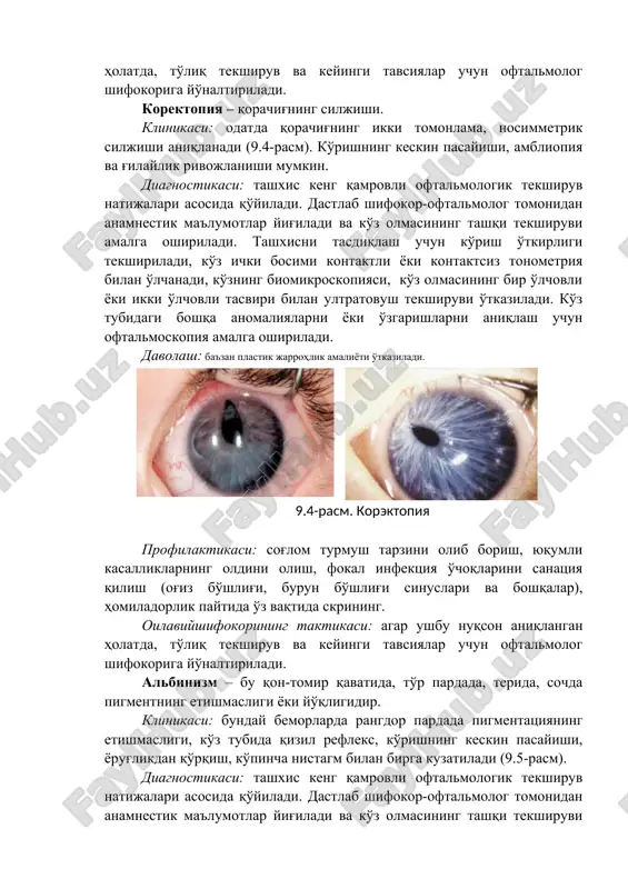i o'tkaziladi. 9.4-rasm. korektopiya profilaktikasi: sog'lom turmush tarzini olib borish, yuqumli kasalliklarning oldini olish, fokal infektsiya o'choqlarini sanatsiya qilish (og'iz bo'shlig'i, burun bo'shlig'i sinuslari va boshqalar), homiladorlik paytida o'z vaqtida skrining. oilaviyshifokorining taktikasi: agar ushbu nuqson aniqlangan holatda, to'liq tekshiruv va keyingi tavsiyalar uchun oftalmolog shifokoriga yo'naltiriladi. albinizm – bu qon-tomir qavatida, to'r pardada, terida, sochda pigmentning etishmasligi yoki yo'qligidir. klinikasi: bunday bemorlarda rangdor pardada pigmentatsiyaning etishmasligi, ko'z tubida qizil refleks, ko'rishning keskin pasayishi, yorug'likdan qo'rqish, ko'pincha nistagm bilan birga kuzatiladi (9.5-rasm). diagnostikasi: tashxis keng qamrovli oftalmologik tekshiruv natijalari asosida qo'yiladi. dastlab shifokor-oftalmolog tomonidan anamnestik ma'lumotlar yig'iladi va ko'z olmasining tashqi tekshiruvi amalga oshiriladi. tashxisni tasdiqlash uchun ko'rish o'tkirligi tekshiriladi, ko'z ichki bosimi kontaktli yoki kontaktsiz tonometriya bilan o'lchanadi, ko'zning biomikroskopiyasi, ko'z olmasining bir o'lchovli yoki ikki o'lchovli tasviri bilan ultratovush tekshiruvi o'tkaziladi. ko'z tubidagi boshqa anomaliyalarni yoki o'zgarishlarni aniqlash uchun oftalmoskopiya amalga oshiriladi. 9.5-rasm. albinizm davolash: davolash talab etilmaydi. …
