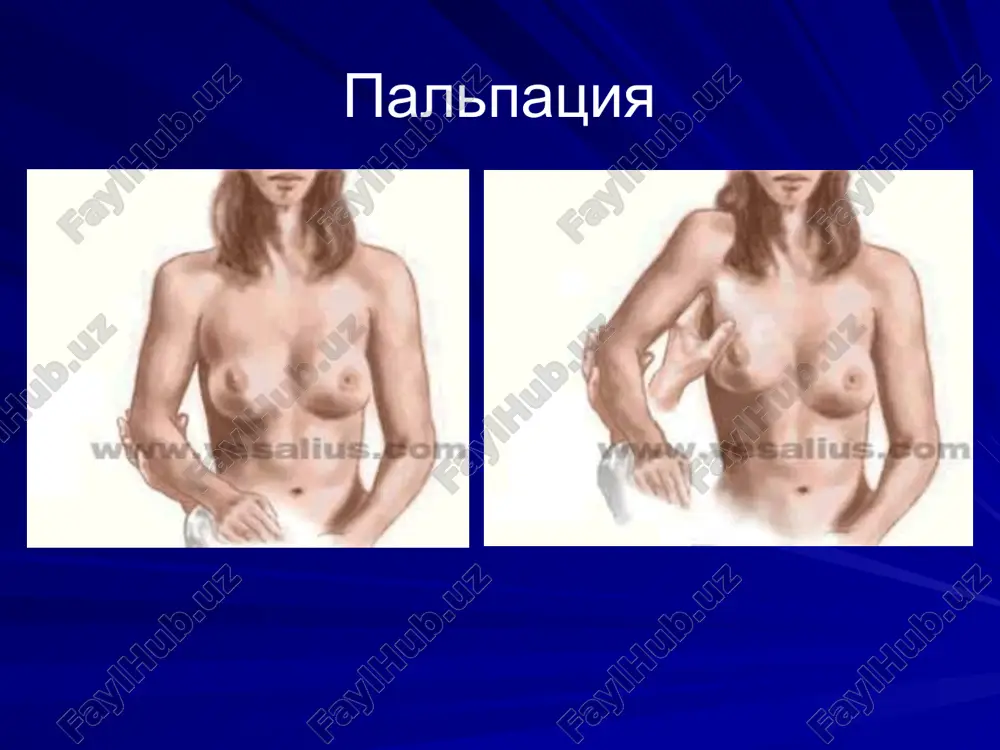 hastkom); radioizotopnaya diagnostika raka molochnoy jelezi osushestvlyaetsya s ispolzovaniem radioaktivnogo fosfora 32r (tolko esli opuxol ne glubje 0,5 sm pod kojey); limfografiya; metod radioizotopnoy limfostsintigrafii osnovan na tom, chto metastaticheski izmenennie limfaticheskie uzli chastichno ili polnostyu teryayut sposobnost nakaplivat izotopi, poetomu na stsintigrammax viyavlyayutsya defekti nakopleniya. metod chrezgrudinnoy flebografii, ispolzuemoy, dlya viyavleniya porajeniya metastazami parasternalnix limfaticheskix uzlov. kompyuternie metodi issledovaniya (kt, mrt). mammogramma pri rake molochnoy jelezi ultrazvukovaya kartina raka molochnoy jelezi kompyuternaya tomogramma pri rake molochnoy jelezi differentsialniy diagnoz mejdu dobrokachestvennoy opuxolyu i rakom molochnoy jelezi (l.m.ratner) simptomi zlokachestvennie dobrkachestvennie polojenie grudnix jelez na bolnoy storone raspolojena vishe urovne stoyanie na odnom urovne koja nad opuxolyu spayana s opuxolyu, vtyanuta, imeet vid pupka ili "limonnoy korki" podvijna, normalnogo tsveta vremya poyavleniya boli poyavlyayutsya pozdno poyavlyayutsya rano (svyaz s menstruatsiyami) palpatornie dannie xryashevidnoy plotnost uzlovataya, melkoy zernistosti net. tesno spayana s okrujayushimi tkanyami i nepodvijna. granitsi nechetkie. koja nad opuxolyu …