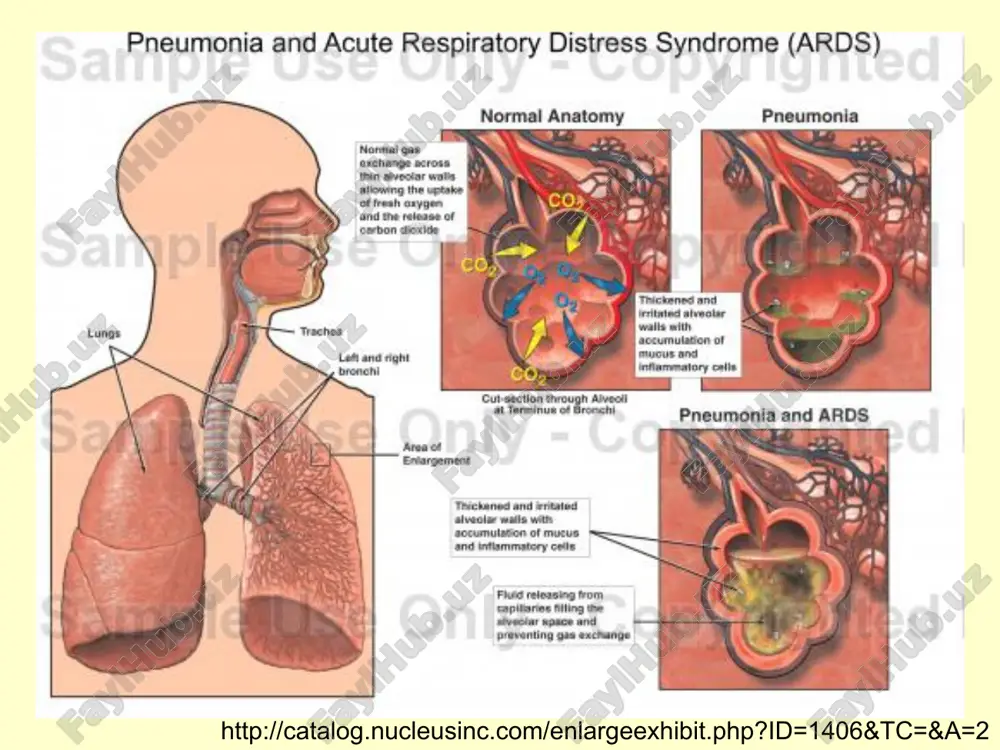 tsin, amikatsin, streptomitsin, ftorxinoloni… * esli vrach ne uveren v diagnoze pnevmoniya, esli ne isklyuchaet tuberkulyoz, to mojno primenyat beta-laktami (penitsillin, ampitsillin, amoksitsillin, oksatsillin, tsefazolin, tseftriakson), makrolidi (azitromitsin, klaritromitsin,eritromitsin), tetratsiklini i ix sochetaniya… * vremya vvedeniya pervoy dozi antibiotika eksperti schitayut netselesoobraznim ukazivat konkretnoe «vremennoe okno» kak chetkiy orientir nachala antibakterialnoy terapii. vmeste s tem, eksperti rekomenduyut nachinat lechenie kak mojno ranshe posle ustanovleniya diagnoza pnevmonii * osobennost rekomendatsiy po lecheniyu vp otsutstvie tsefalosporinov pervoy generatsii, linkomitsina, gentamitsina, ko-trimoksazola, otxarkivayushix, bronxolitikov, antigistaminnix, nspvs immunostimulyatorov narkoticheskix analgetikov * materinstvo pri beremennosti dopustimo primenenie antibiotikov beta-laktamnogo ryada, makrolidov, metronidazol, protivopokazani ftorxinoloni, tetratsiklini, aminoglikozidi, linkosamidi, ko-trimoksazol. pri grudnom vskarmlivanii dopustimi s ostorojnostyu penitsillini, tsefalosporini, ne rekomenduyutsya makrolidi, ftorxinoloni, karbapenemi, tetratsiklini, linkosamidi, ko-trimoksazol. * prodoljitelnost antibakterialnoy terapii pri netyajyoloy vp – 7-10 dney pri tyajyoloy vp ne menee 14 dney pri mikoplazmennoy, legionellyoznoy ili xlamidiynoy vp 14 dney kriteriy otmeni stoykaya normalizatsiya temperaturi tela …