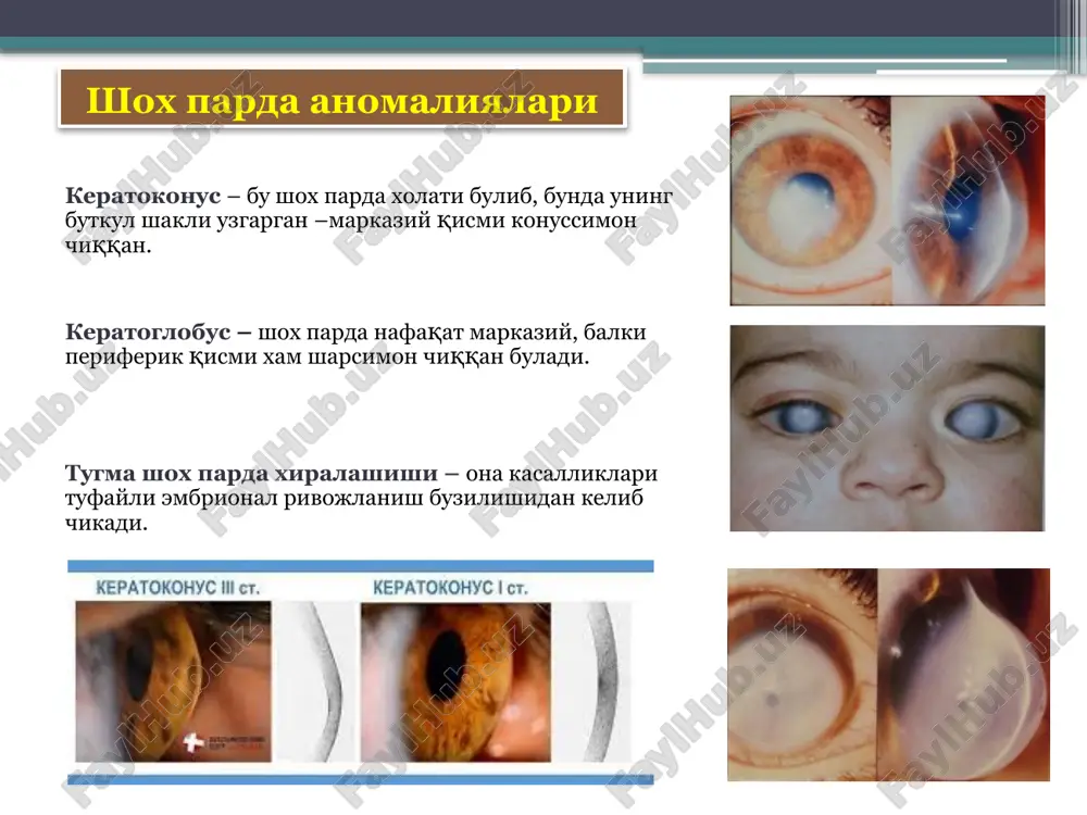 bo'ylab virus tarqalishi bilan tushuntiriladi). yaqqol shox parda sindromi perikorneal qon tomir in'ektsiyasi shox parda sezgirligi pasaygan vaskulyarizatsiya 30% xollarda kasallik qaytalanishi mumkin disksimon gerpetik keratitlar shox parda chuqur qavatida oqimtir-kulrang infiltrat paydo bo'lishi xar doim iridotsiklit bilan kechadi shox parda sindromi va perikorneal in'ektsiya kuchsiz namoyon bo'lgan yallig'lanish jarayoni kechishi bir necha oylab vaskulyarizatsiyasiz sust kechadi kasallik dag'al belmo xosil bo'lishi bilan yakunlanib, unda uzoq payt uncha katta bo'lmagan yallig'lanish o'chog'i saqlanib turadi gipo- i avitaminoz keratitlar organizmga etarli miqdorda vitaminlarni ovqat orqali kirishi yoki so'rilishini buzilishi yoki organizmda vitaminlar almashinuvi buzilishi bilan bog'liq. shox parda ko'pincha a avitaminozida, kam xollarda v1, v2, s, rr, e avitaminozida zararlanadi shox parda zararlanishi prekseroz, kseroz va keratomalyatsiya ko'rinishida namoyon bo'ladi keratomalyatsiya — avitaminoz a ning og'ir ko'rinishi bo'lib, kasallik ko'pincha emizikli bolalarda uchraydi shox pardaning infiltratsiyalangan soxalari ko'chadi. shox parda sezgirligini yo'qotgan va uning erish jarayoni og'riqsiz kechadi. jarayon belmo xosil …