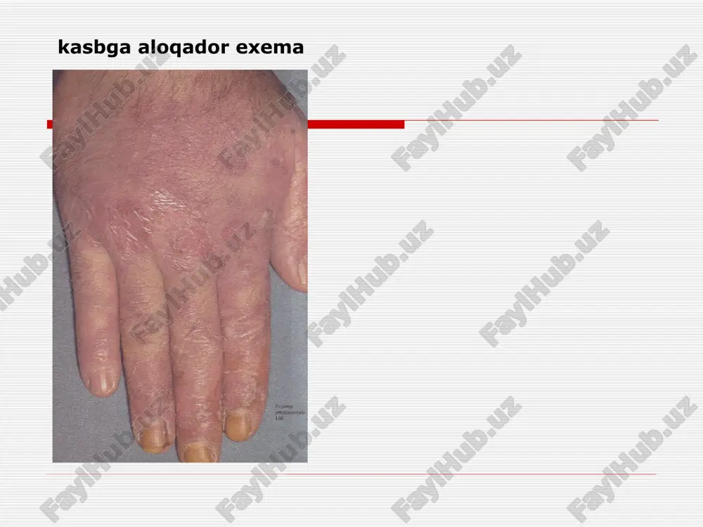 ntizaciya mehnat charoitlarini yachshilash atopik dermatit nasldan utadigan alllergik dermatoz surunkali kechuvchi ,qaytalanuvchi dermatoz . qichishish ,eritema ,tugunchalar paydo buladi , liheniszaciya eshak emi utkir va surunkali kechuvchi birlamchi toshma – urtika differencial diagnoz –dermatit duringa bilan eshak emi neyrodermit surunkali kechuvchi terining yalliglanishi . bu kasallikda eritematoz –lichenoidli toshmalar paydo buladi , bir biri bilan qushilgan. papulez infiltraciya uchoqlari paydo buladi va kup toshadigan joylarda lihenizaciya kuzatiladi neyrodermit turlari chegaralangan diffuz uchta zona markaziy (lihenizaciya ) urta (papulez ) periferik (giperpigmentaciya) qiyesiy tashhis (surunkali kechuvchi exema, qishima) qichima surunkali kechuvchi dermatoz –tugunchalar hosil buladi turlari : bolalar qichimasi (strofulus ) kattalar qichimasi tugunli qichima differencial tashhis –neyrodermit , kpl davolash komplexli asab, asab endokrin uzgarishlarni davolash infekciya uchoqlarini sanaciyasi gipoallergik diyeta sedativ vositalar giposensibilizacion terapiya immunokorregent vositalar the subject: dermatitis, toksikodermia, eczema, itching dermatosis, urticaria. dermatitis, inflammation of the skin, caused by direct impact of various exogenous factors and …