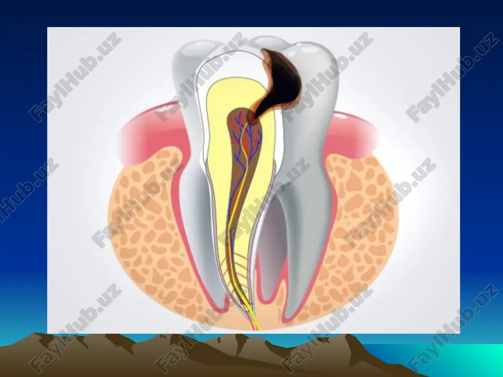 dlya xronicheskogo fibroznogo pulpita, pri kotorom samoproizvolnaya bol mojet voznikat tolko pri obostrenii protsessa vospaleniya pulpi; 2). pri ostrom ochagovom pulpite (za isklyucheniem travmaticheskogo) net soobsheniya karioznoy polosti s pulparnoy kameroy. pri xronicheskom fibroznom pulpite posle provedennoy nekrektomii ono, kak pravilo, obnarujivaetsya; 3). pokazateli eod pri ostrom ochagovom pulpite- do 20mka, a pri xronicheskom fibroznom –do 35-40mka; 4). iz anamneza pri ostrom ochagovom pulpite ne viyavlyayutsya samoproizvolnie boli v proshlom, v otlichie ot xronicheskogo fibroznogo pulpita. 5). ostriy ochagoviy pulpit sushestvuet 1-2 sutok, a xronicheskiy fibrozniy-do neskolkix let. esli pulpit obnarujen pri profilakticheskom lechenii, to on, kak pravilo, yavlyaetsya xronicheskim. obshee: 1). dlitelnie boli, voznikayushie ot razdrajiteley, osobenno ot xolodnogo; 2). zondirovanie dna karioznoy polosti boleznennoe v odnoy tochke. differentsialnaya diagnostika ostrogo ochagovogo pulpita i papillita. ostriy ochagoviy pulpit neobxodimo differentsirovat s papillitom, pri kotorom vsegda viyavlyaetsya giperemirovanniy desnevoy sosochek, krovotochashiy pri legkom zondirovanii. pokazateli eod ryadom stoyashim zubov v …