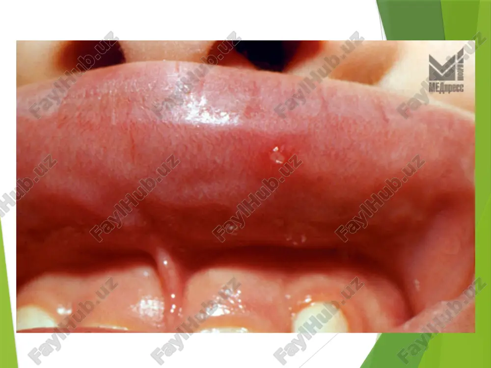 kogo stomatita 24 sredstva keratoplasticheskoy terapii karatolin aevit maslo shipovnika vitamini a i e v maslyanom rastvore aerozoli: gipozol,olazol,inozol printsipi lecheniya ostrogo gerpeticheskogo stomatita 25 sredstva protivovirusnoy terapii obshego deystviya bonafton – po 1 t. 3 raza v den (nerazjevivaniya).kurs lecheniya –10 dney dnkaza –v/m po 500 mg na fizr-re 1 r. v sutki. kurs lecheniya 10 dney alpizarin vnutr po 1 tabl.(0,1 g) 3 raza vden. kurs lecheniya 1-15 dney lizotsim v/m po 100 mg 2 raza v den. kurs lecheniya- 20 in'ektsiy printsipi lecheniya ostrogo gerpeticheskogo stomatita 26 sredstva protivovirusnoy terapii obshego deystviya interferon (iz donorskoy krovi).v/m po 500 mg (1ml ) 1 raz v 3-4 dnya. kurs lecheniya 4-5 in'ektsiy kombinirovanie interferona vmeste s induktorami interferonogenov (prodigiozan, gammaglobulin, levamizol) -prodigiozan (polisaxarid) v kachestve protivoretsidivnoy terapii. v/m, nachinaya s dozi 0,3 ml 1 raz v 5 dney, uvelichivaya do 1 ml. vsego 7 in'ektsiy. printsipi lecheniya ostrogo gerpeticheskogo …
