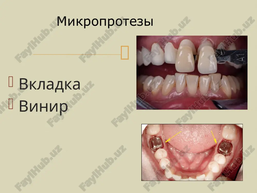 dividualnoy klinicheskoy kartini. konsultatsiya s bolee opitnim vrachom. 2. nepravilniy vibor chisla opornix zubov ili vibor pod oporu neprigodnix zubov. eto mojet bit pri nepolnom sbore anamneza, poverxnostnom obsledovanii polosti rta, prenebrejenii dannimi rentgenodiagnostiki, otsutstvii issledovaniya diagnosticheskix modeley. 3. oshibki pri podgotovke polosti rta k protezirovaniyu pri otsutstvie etoy podgotovki. oshibki pri protezirovanii s'emnimi konstruktsiyami protezov.  osoboe vnimanie nujno udelit podgotovke slizistoy obolochke proteznogo loja. dlya normalizatsii formi alveolyarnogo grebnya primenyayut alveoloplastiku — vosstanovlenie alveolyarnogo grebnya v bezzuboy chasti. vozmojnie sposobi: 1. uglublenie preddveriya polosti rta i uglublenie dna polosti rta. 2. ispolzovanie implantantov ili transplantatov, chtobi pridat alveolyarnomu grebnyu normalnuyu formu. v kachestve transplantatov ispolzuyut rebra, grebeshok podvzdoshnoy kosti, razlichnie plasticheskie materiali (silikon, ftoroplast) v razlichnoy forme: v vide blokov, granul. esli eto melkie granuli, to, sozdav tonnel pod slizisto-nadkostnichnim loskutom, rastyanuv ego spetsialnimi espanderami, pri pomoshi shpritsa vvodyatsya v nego eti granuli i v rezultate poluchaetsya iskusstvenniy …