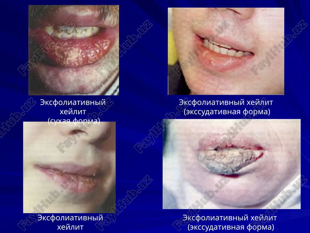 utolshen i naplivaet na kraya defekta. v okrujayushey soedinitelnoy tkani nablyudaetsya kruglokletochnaya infiltratsiya. v bolee glubokix sloyax sobstvennoy plastinki viyavlyaetsya fibroz. diagnostika xronicheskoy treshini gubi ne vizivaet trudnostey. lechenie. neobxodimo ustranit prichinu zabolevaniya. primenyayut mazi, soderjashie antibiotiki, kortikosteroidi, sredstva, stimuliruyushie epitelizatsiyu. xoroshiy effekt daet dlitelniy priem vitamina a i vitaminov gruppi v. pri otsutstvii effekta provodyat xirurgicheskoe issechenie treshini v predelax zdorovix tkaney. inogda voznikaet ne obxodimost v rekonstruktivnoy operatsii gubi. xronicheskaya treshina gubi glandulyarniy xeylit glandulyarniy xeylit otnositsya k gruppe sobstvenno xeylitov. razvivaetsya v rezultate giperfunktsii, giperplazii ili geterotopii malix slyunnix jelez. rasprostranennost. chashe boleyut mujchini v vozraste 50-60 let. formi. pervichniy (razvivaetsya bez predshestvuyushix zabo­levaniy krasnoy kaymi i slizistoy obolochki gub). vtorichniy (yavlyaetsya sledstviem xronicheskix vospalitelnix zabolevaniy etoy oblasti, naprimer, krasnogo ploskogo lishaya ili krasnoy volchanki). lokalizatsiya. zona perexoda krasnoy kaymi v slizistuyu obolochku, reje krasnaya kayma. simptomi. suxost krasnoy kaymi vsledstvie ispareniya slyuni s ee poverxnosti. klinicheskaya …