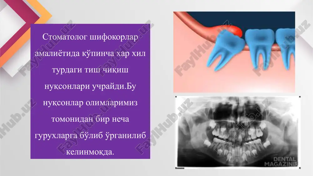 ng o'ziga xos xususiyatlari. yuqori jag'dagi kesuvchi va qoziq tishlarni olishda og'iz dahlizi tomonidan o'tuv burmasining eng yuqori qismidan alveolyar o'siqqacha retentsiyalangan hamda noto'liq retentsiyalangan tish toj qismi joylashgan sohaga qadar ikki tomonlama kesishgan kesuv o'tkaziladi. hosil qilingan laxtak tish chegarasini qoplashi zarur. laxtak ajratilib, tish ustidagi suyak to'qimasi bormashina yordamida olinadi. tishni maxsus ombur yoki elevator yordamida olinadi. tish olinayotgan vaqtda qo'shni tish ildizining uchi zararlansa, shu tish ildizining apikal qismini retrograd usulida plombalab, bir vaqtning o'zida ildiz uchi rezektsiyasini o'tkazish tavsiya etiladi. tish olingandan so'ng hosil bo'ladigan suyak bo'shlig'iga, burun shilliq qavatini zararlab qo'ymaslik maqsadida, ehtiyotkorlik bilan ishlov beriladi. alohida guruh tishlarini olishning o'ziga xos xususiyatlari. agarda to'liq yoki noto'liq retentsiyalangan tishlarning ildiz qismi og'iz dahliziga qaragan bo'lib, toj qismi tanglay tomonda joylashgan bo'lsa, bunday tishlarni olishda katta qiyinchiliklar yuzaga kelishi mumkin. bunday hollarda tishlarni ikki qismga ajratib, alohida-alohida qilib olinadi. yuqori jag'ning tanglay o'sig'ida joylashgan tishlarni olish …