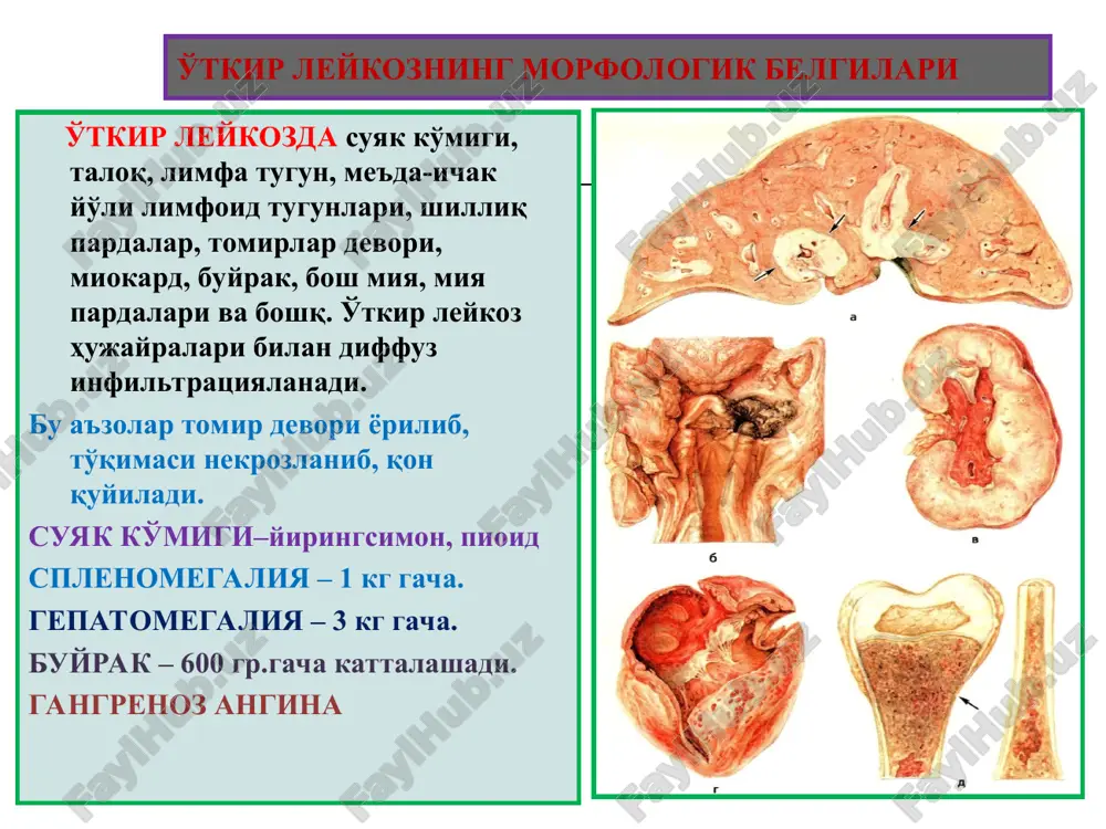 va shillik pardalarda qon quyilishlari. mikro: naysimon suyaklar iligida eritrovoez yosh xujayralari giperplaziyasi. ichki organlarda ekstramedulyar qon yaratish o'choqlari, buyrak kanalchalarida parenximatoz yogli distrofiya. rasm buyrak yog'li distrofiyasi anemiya ii. gemolitik anemiya turlari: 1. intravaskulyar gemolizli gemolitik anemiya: toksik anemiya(gemolitik zaxarlar, ogir kuyishlar) infektsion anemiya(bezgak sepsis) posttransfuzion anemiya( r+omil va kon guruxi boshka kon kuyishda) chakaloklar gemolitik kasalligi autoimmun gemolitik anemiya(leykoz, virusli infektsiya, sistemali kasalliklar) 2. ekstravaskulyar gemolizli gemolitik anemiya irsiy anemiyalar eritrotsitopatiya eritrotsitofermentopatiya gemoglobinopatiya umumiy patomorfologik uzgarishlar: umumiy gemosideroz; gemolitik sariklik; splenomegaliya; gemoglobinuriyali nefroz; yassi suyaklar kumigi tuk va binafsha-kizil rangli; naysimon suyaklar iligi kizil rangli. xususiy patomorfologik uzgarishlar: eritrotsitopatiyaning irsiy sferotsitoz xilida: konda mikrosferoid eritrotsitlar va retikulotsitoz; sezilarli splenomegaliya(1000g); kuz va shillik pardalar sarik, siydik va axlat tuk rangli. 2. gemoglobinopatiya uroksimon xujayrali anemiyasida: sababi- v globin geni mutatsiyasi; mexanizmi- kaltsiy tuplanib suv va kaliyning kamayishi natijasida eritrotsitlar membranasi rigidlanadi. eritrotsitlar talokda sekvestrlanib 20kunda nobud buladi rigidlangan uroksimon …