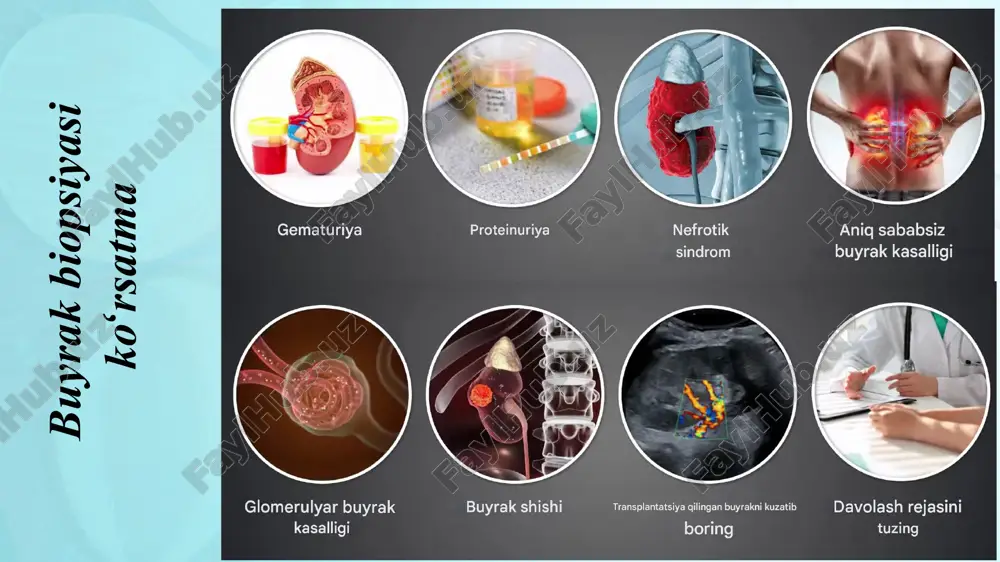 ladi. buyrak biopsiyasi bilan bog'liq xavflar qanday? asosiy xavf shundaki, biopsiya buyraklar yoki boshqa yaqin organlarga (jigar, taloq, o'n ikki barmoqli ichak, oshqozon osti bezi, plevra va o'pka, siydik yo'llari, pastki vena kava) zarar etkazishi mumkin. eng jiddiy asorat qon ketishdir. qon quyish, buyrak angiografiyasi va embolizatsiya, ba'zan esa jarrohlik talab qilinishi mumkin bo'lgan katta qon tomirlarining teshilishi, garchi bu juda kam uchraydi. juda kamdan-kam hollarda biopsiya asoratlari qon ketishi tufayli bemorning o'limiga olib kelishi mumkin. shuningdek, kam uchraydigan asoratlar orasida buyrakning pastki qutbining yorilishi, yiringli paranefrit (buyrak atrofidagi yog 'to'qimalarining yiringli yallig'lanishi) ni ko'rsatish mumkin. ponksiyon bilan bog'liq mushaklarning qon ketishi ham mumkin, bu og'riq va noqulaylik tug'dirishi mumkin. noto'g'ri biopsiya yoki buyrakning noto'g'ri joylashishi tufayli plevra bo'shlig'iga havo kirishi tufayli pnevmotoraks juda kam uchraydi. buyrak biopsiyasining afzalliklari nimada? buyrak biopsiyasi buyrak kasalligini tashxislashning yagona ishonchli usuli bo'lib, shifokorga kasallikning og'irligini ob'ektiv baholash, eng to'g'ri davolash usulini tanlash, nojo'ya …