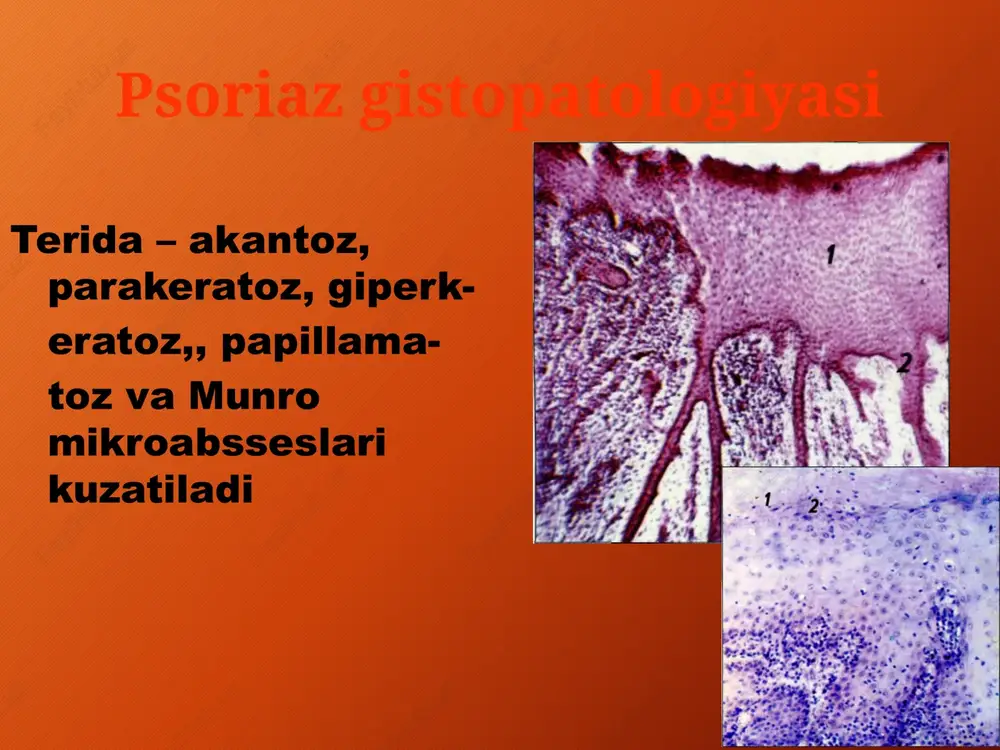 undan so'ng, har bir mintaqa uchun biz o'z indeksimizni quyidagi formula bo'yicha aniqlaymiz: (eritema + eksfoliatsiya + infiltratsiya) * zarar darajasi * mintaqaning vazn koeffitsienti hududning vazn koeffitsienti terining sirt maydoniga to'g'ri keladi: 0,4 – oyoq, 0,3 – magistral, 0,2 – qo'llar, 0,1 – bosh. 4 mintaqaning har biri uchun indeksni hisoblab chiqqandan so'ng, olingan ko'rsatkichlarni umumlashtiramiz va pasining umumiy umumiy indeksini olamiz psoriaz bilan og'rigan bemorlarni hisoblangan pasi qiymatiga qarab boshqarishning terapevtik taktikasi aralashuv talab qilinadi - pasi >60% aralashuv tavsiya etiladi - pasi bo'yicha 30-60% aralashish tavsiya etilmaydi - pasi < 30% psoriazda tirnoqlar o’zgarishi ko’p uchraydi (onychia psoriatica), nuqta-nuqta botiqlar ( angishvona simptomi ) , tirnoqlarning qalinlashishi va ularning sinishi kuzatiladi davolash mahalliy davo 1. kortikosteroidli malhamlar – elokom, momat, advantan. 2. d3 vitaminining sintetik analogi – psorkutan. 3. statsionar va regress bosqichlarida teridagi infiltratlarni tez so`riltirish maqsadida naftalan va ixtiol. umumiy davo 1.antigistamin dorilar – dimedrol, …
