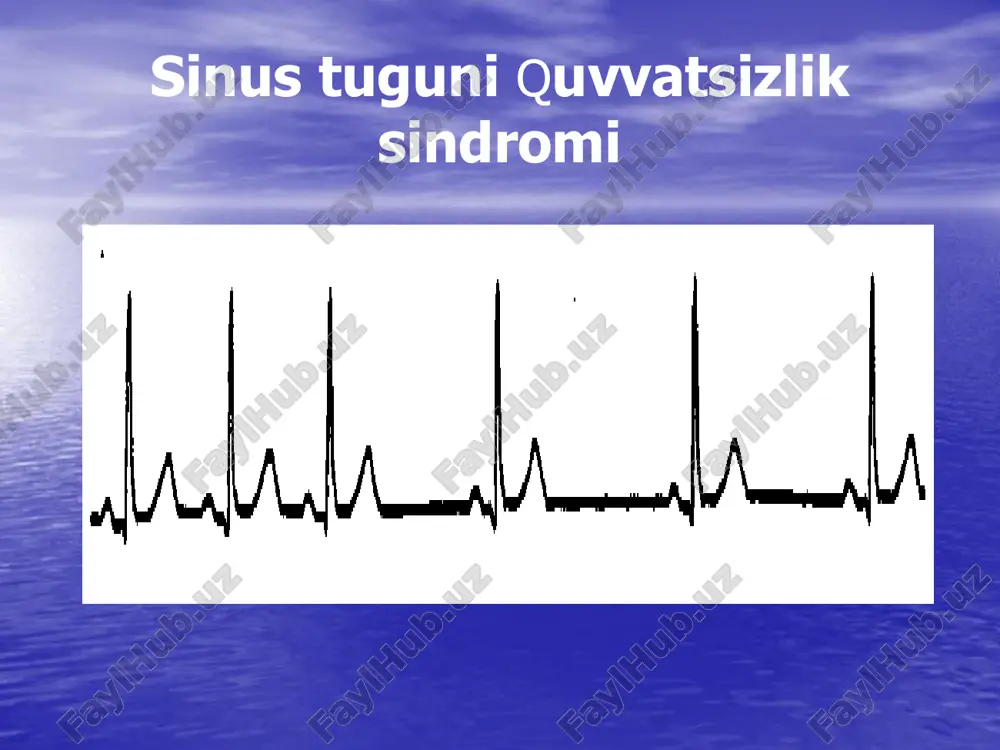 renalin, efedrin. qorincha bilan bog'liq ekstrasistoliyada –lidokain v/v tomchilab. qorincha bilan bog'lik xurujli taxikardiya: shunday+defibrilyatsiya. sinusli bradikardiyada – atropin+elektrstimulyatsiyasi atrioventrikulyar blokadada to'la yoki 2:1- elektrstimulyatsiyasi sinusli taxikardiyada –yurak glikozidlari +betablokatorlar xuruj-n t-ya (supraventrikulyar)- reflektorli sinamalar, yurak glikozidlari, inderal, izoptin, elektr defibrillyatsiyasi sinusli bradikardiyada – atropin+elektrstimulyatsiyasi atrioventrikulyar blokadada to'la yoki 2:1- elektrstimulyatsiyasi sinusli taxikardiyada –yurak glikozidlari +betablokatorlar xuruj-n t-ya (supraventrikulyar)- reflektorli sinamalar, yurak glikozidlari, inderal, izoptin, elektr defibrillyatsiyasi bulmalarning tebranishi titrashi – yurak glikozidlari, obzidan, izoptin, nolvokainamid, kordaron, elektr defibrillyatsiyasi. bulimlar ekstrasistoliyasi- beta-blokatorlar, izoptin, kordaron. beta-blokatorlar, kordaron, xinidin, novokainamid tula yokt tula bulmagan a/v blokadada kullab bulmaydi, yue va gipotenziv xolatlarda nisbiy kullab bulmaydi. lidokain,trimekain- utkazuvchinlikni buzilishi, yue, gipotenziyada. yurak glikozidlari. beta-stimulyatorlar, xolinolitiklar- gipertenziya, taxikardiya,glikozidlar bilan zaxarlanish, a/v blokada, idiopatik subaortal stenozlarda kullab bulmaydi òtkir yurak yetishmovchiligi. sabablari: jismoniy zurikish, yukumli kasalliklarda, intoksikatsiyada, pnevmoniyalarda, ogn, eksudativ plevritda, vps, endomiokarditlarda. uyueni 2 turi, ung va chap korinchalar yetishmovchiligi tafovut qilinadi. chap korincha …