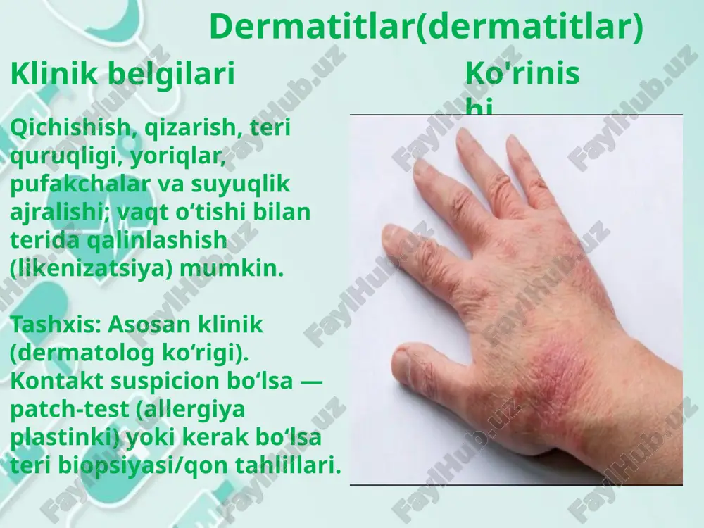 ichishuvchi, chekkalari aniq ko‘tarilishlar; odatda bir necha soatdan kungacha davom etadi va boshqa joyda takror paydo bo‘ladi. ba’zan angioedema — chuqur to‘qimalarning shishishi (og‘iz, ko‘z, lablar, tomoq) bo‘lishi mumkin. tashxis: asosan anamnez va namoyon bo‘lgan toshma ko‘rinishi asosida; kronik holatlarda qo‘shimcha tekshiruvlar (qon tahlillari, allergen testlari) kerak bo‘lishi mumkin. klinik belgilar: *tez paydo bo‘luvchi qichishuvchi, chekkalari aniq ko‘tarilishlar; odatda bir necha soatdan kungacha davom etadi va boshqa joyda takror paydo bo‘ladi. ba’zan angioedema — chuqur to‘qimalarning shishishi (og‘iz, ko‘z, lablar, tomoq) bo‘lishi mumkin. tashxis: *asosan anamnez va namoyon bo‘lgan toshma ko‘rinishi asosida; kronik holatlarda qo‘shimcha tekshiruvlar (qon tahlillari, allergen testlari) kerak bo‘lishi mumkin. davolash: *antihistamin dorilar (ko‘pincha sedatsiyasiz 2-chi avlod preparatlari — cetirizine, loratadin, feksofenadin) asosiy davodir. *agar antihistaminlar yordam bermasa — yuqori dozalarga ko‘tarish, montelukast, doxepin yoki omalizumab (og‘ir, kronik holatlar) kabi dori variantlari. *agar anafilaksiya yoki nafas qisilishi bo‘lsa — epinefrin va shoshilinch tibbiy yordam. oldini olish: tetiklovchilarni …