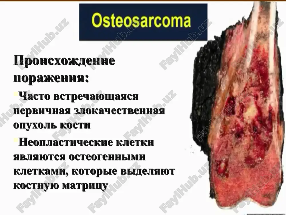 sarkoma, nachalnaya stadiya razvitiya dz: revmatoidniy poliartrit, «pyatnistiy osteoporoz». r-ski: uchastki osteoliticheskoy destruktsii, s nechetkimi konturami. cherez 3 mes – noyushie boli - rasprostranenie protsessa. xondrosarkoma chastota po otnosheniyu k bolnim s pervichnimi zlokachestvennimi opuxolyami kostey sostavlyaet 13% pervichnie xondrosarkomi obichno svoystvenni litsam starshe 30 let v detskom vozraste xondrosarkoma vstrechaetsya redko . davolash osteosarkomani davolash muhim tarkibiy kismlari: 1. operatsiya oldi ximioterapiasi hamma vaqt davolashning chi bosqichi bolib hisoblanadi va quyidagi afzalliklarga ega: sistem o`smani nazoratini yaxshilash – o`pkalardagi mikrometastaz- larni bosib turish; birlamchi ochoqni nazorat qilish- bu oyoq – qollarda rekonstruktiv operatsiyalar otkazish imkoniyatini beradi; o`smaning ximioterapiyaga javobini obyektiv aniqlash imkoniyati, bu esa kasallik oqibatini oldindan aytish va kelgusi davolanish taktikasini aniqlashga yordam beradi. zamonaviy osteosarkomani davolashda quyidagi ximiopreparatlar ishlatiladi : yuqori dozali metotreksat (8-12 g/m2), adrioblastin , ifosfamid, platina preparatlari(karboplatin, tsisplatin), etopozid. davolash operatsiya — davolashning rad qilib bolmaydigon 2 - bosqichidir . butun jahonda bogimlar endeprotezlarini …