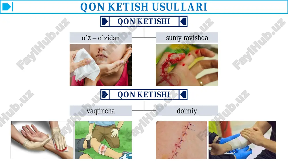 bo'shlig'iga (masalan, taloq olib tashlanganda, uning o'rnidan qon ketsa) doka tampon tikib qo'yiladi. qon oqayotgan tomir ma'lum bo'lmasa, ko'pincha doka yoki bintdan tayyorlangan ingichka tamponlar batamom qon ketishini to'xtatishning birdan-bir yo'li hisoblanadi. masalan, bu usul vena sinuslari va chigallaridan, qin, burun va suyak bo'shlig'idan, milklardan qon ketganda yaxshi ta'sir ko'rsatadi. abu ali ibn sino «tib qonunlari» ning iv kitobida yaradan qon ketganda tamponlardan foydalanganini, ularni olib tashlashda organizm asta-sekin o'zi tashqariga itaradi, deb eslatib o'tadi. qo'yilgan tampon to'qimalarni ezib turishi sababli 48 soat dan uzoq muddat qo'yilmasligi kerak, uni antiseptik moddalar qo'llab, shilliq qavatni shikastlantirmasdan avaylab olinadi. qorin bo'shlig'iga qo'yilgan tampon birdaniga olib tashlanmaydi, avval u o'rnidan siljitiladi, keyingi kunlarda sekin tortib olinadi, bunda bemorga og'riq qoldiruvchi moddalar qilinadi. qon ketishini to'xtatishning termik usullari past haroratdan qonni to'xtatish uchun foydalanish qadimdan ma'lum. ko'pincha rezina idishga sovuq suv, qor yoki muz to'ldirilib shikastlangan sohaga qo'yiladi. past harorat tomirlar devorini toraytiradi, tromb …