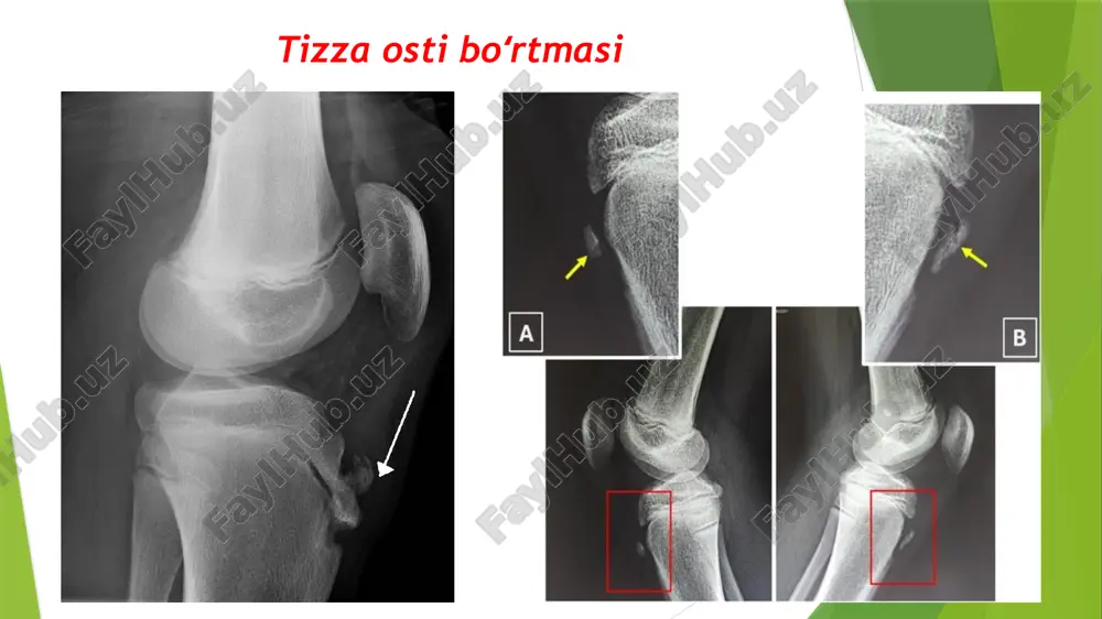 osteoxondropatiyalar va skolioz - Page 4