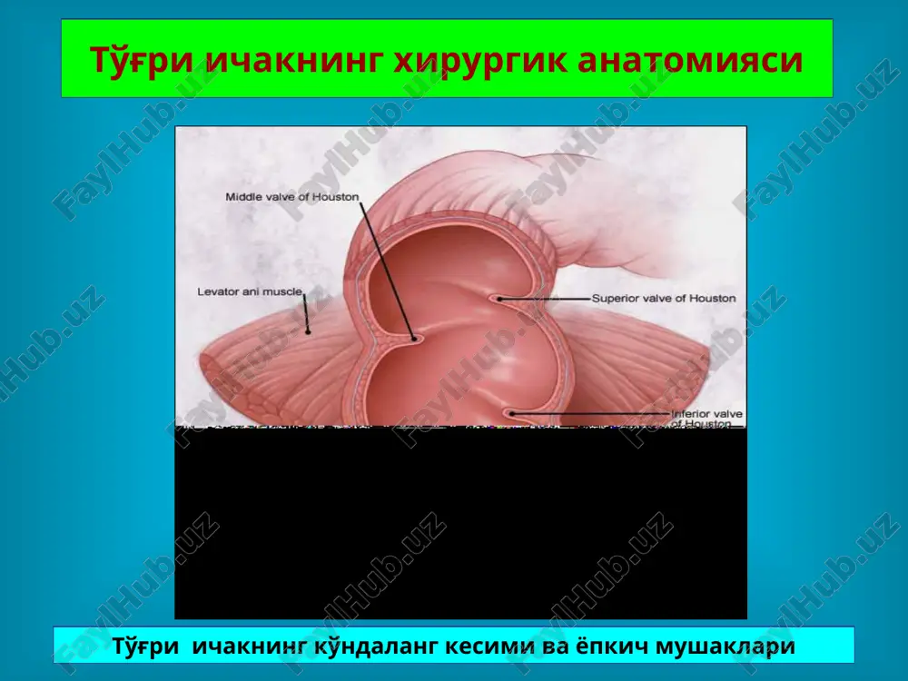 iqda xojatdan keyin qon tomchilari ajralib chiqishi kuzatiladi. orqa chiqaruv teshigi yorig'i ichki sfinkterotomiya. a) orka chikaruv teshigi yorigi va ichki sfinkterni kesish b) sxematik tasvir, v) shpatellar olingandan keyin jaroxat xolati orqa chiqaruv teshigi yorig'i maxalliy yoki endotraxeal narkoz ostida radial yunalishli urab oluvchi kesma bilan orka chikaruv teshigi gipertrofiyalangan yorigi va karunkula olib tashlananadi o'tkir paraproktit va paraproktal oqma paraproktit pararektal kletchatkaga infektsiya tushishi natijasida vujudga keladi. pararektal kletchatkaga mikroblar anal kriptalarga ochiladigan anal bezlardan tushadi. anal bezdagi yallig'lanish jarayoni natijasida uning yo'li bekiladi va sekret oqib chiqishi buziladi. o'tkir paraproktit paydo bo'lishiga moyillik tug'diradigan sabablar orasida to'g'ri ichak distal bo'limi va anal kanal shilliq pardasidagi mayda shikastlar birinchi o'rinda turadi. paraproktal abstsess va paraproktal oqma davrlari utkir paraproktit – abstsess surunkali paraproktit - paraproktal okma o'tkir paraproktit parakproktal abstsesslar: a) perianal, ), ishiorektal, s) pelviorektal, d) shillik osti o'tkir paraproktit klinikasi og'riq qizarish shish tana xarorati kutarilishi …