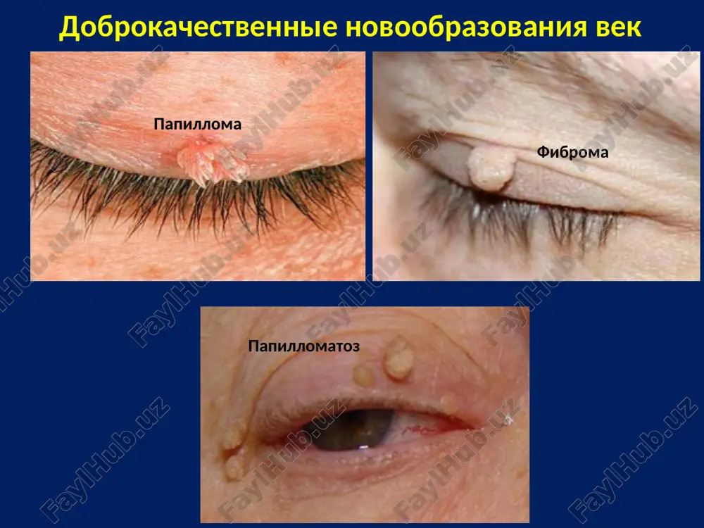 етоды лечения внутриглазных опухолей оперативное лечение лазеркоагуляция криотерапия брахитерапия протонотерапия химиотерапия гамма нож витреоретинальная хирургия с предварительной r-терапией и химиотерапией линник л.ф. был выдающимся ученым, высокопрофессиональным врачом, интеллигентным, стойким и мужественным человеком. он вошел в историю мировой медицины как один из основателей отечественной офтальмологии, создатель научного направления по диагностике и лечению больных с внутриглазными опухолями, атрофией зрительного нерва, разработчик нового поколения интраокулярных линз. заведовал кафедрой офтальмологии оргми, открыл межобластной оренбургский офтальмоонкоцентр. с 1979 по 1996 работал в мнтк «микрохирургия глаза» заместителем генерального директора по научной работе, а с 1996 по 2000 исполнял обязанности генерального директора. с 2000 года и до последних дней жизни леонид феодосьевич был главным научным консультантом мнтк «микрохирургия глаза» им. академика с.н. федорова. леонид феодосьевич линник впервые описана в 1597 г. petraus rawius у ребенка 3-х лет, где было прорастание в орбиту, череп, височную ямку и ребенок погиб. 1767 г. hayes описал случай 2-х сторонней ретинобластомы у …