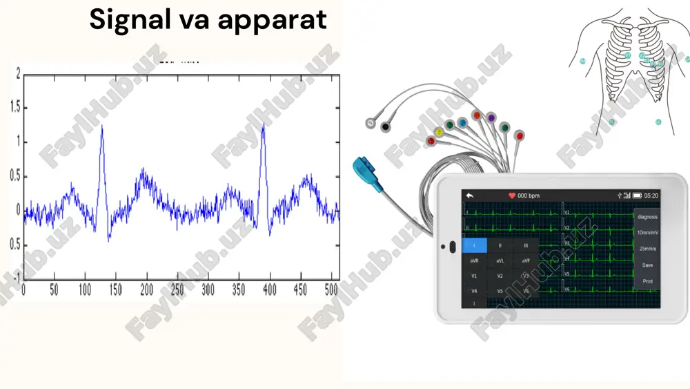 gacha taxminiy va batafsil koeffitsientlarga ajratadi. asosiy signalni driftsiz topish uchun driftning asosiy chizig'iga tegishli hisoblangan koeffitsientlar chiqarib tashlandi va signal idwt yordamida qayta tiklandi. klassifikatsiyalash yig'ilgan ekg signalining xarakteristikalari turli tasniflash usullari yordamida tasniflangan va tan olingan. yozilgan ekg signalining har bir zarbasi uchun hisoblangan avtoregressiv parametrlarni o'z ichiga olgan ko'p o'lchovli matritsalar bu ishning o'ziga xos xususiyati hisoblanadi. k-eng yaqin qo'shni usuli soddaligi tufayli bioinformatika va boshqa sohalarda eng ko'p qo'llaniladigan yondashuvlar qatoriga kiradi, ammo tegishli o'lchov o'lchovlari sifatida k tartibi modelini tanlashda e'tibor berish kerak. ushbu tadqiqotning keyingi bosqichida bemorning xususiyatlarini aniqlaydigan elektrokardiografiya boshqa bioinformatikada qo'llaniladigan chiziqli (lda) va kvadratik (qda) diskriminant tahlili tasniflagichlari yordamida ko'rib chiqildi va baholandi. p va t cho’qqilarni aniqlash fusion algoritm yordamida ekg signal cho’qqilarini aniqlash fusion algoritm r cho’qqilarni aniqlash . aritmiyalarni aniqlash taklif etilgan sxemaning samaradorligini baholash uchun uch xil turdagi ekg signallarini o'z ichiga olgan ekg natijalari to'plami ishlatilgan. …