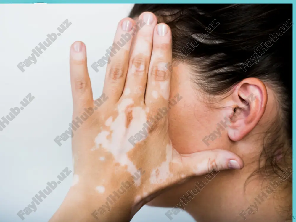 kasalligi (surunkali buyrak usti etishmovchiligi, buyrak usti korteksining disfunktsiyasi, surunkali gipokortizolizm), tuxumdonlarning funktsional holatida buzilishlar kuzatilishi mumkin. 7 vitiligo rivojlanishida stress holatlari, oldingi yuqumli kasalliklar, o'choqli infektsiyaning mavjudligi, ichki organlarning surunkali kasalliklari, intoksikatsiya, terining ma'lum sintetik to'qimalar bilan aloqasi va jismoniy shikastlanish katta ahamiyatga ega. kasbiy vitiligo, masalan, formaldegid patronlarini ishlab chiqarishda yoki kauchuk sanoatida ishlaydigan ishchilarda ham paydo bo'lishi mumkin. • ko'pgina bemorlarda vitaminlar balansi, mis, temir, rux va boshqa mikro va makroelementlar almashinuvining buzilishi aniqlangan, malabsorbtsiya sindromi qayd etilgan. so'nggi yillarda immunitet tizimining buzilishi muhim rol o'ynadi vitiligoning autoimmün patogenezi; terining depigmentatsiyasi pigmentatsiya uchun zarur bo'lgan tirozinaza fermentining shakllanishini bilan izohlanadi. pigment shakllanishi. pigment shakllanishi murakkab biologik hisoblanadi ko'plab omillarga bog'liq bo'lgan terida sodir bo'ladigan jarayon. melanin pigmentining sintezi bazal keratinotsitlar qatlami ostida joylashgan epidermisning melanotsitlarida tirozinaza fermenti ta'sirida aminokislota tirozindan sodir bo'ladi. melanosomalardan (o'ziga xos pufakchalar) sintez qilingan melanin melanotsitlar jarayonlari davomida keratinotsitlarga o'tadi, to'planadi va bir …